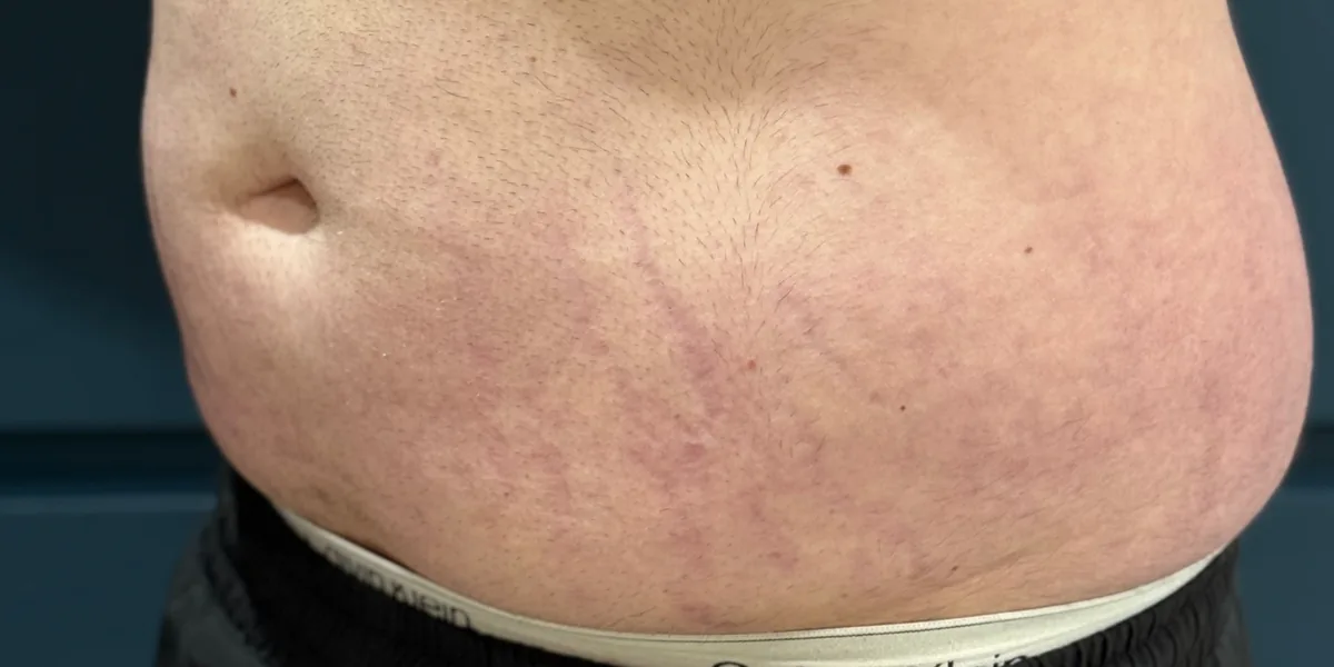 Abdominal stretch marks after two sessions of Morpheus8 Burst — Rejuvena Clinic Bedford