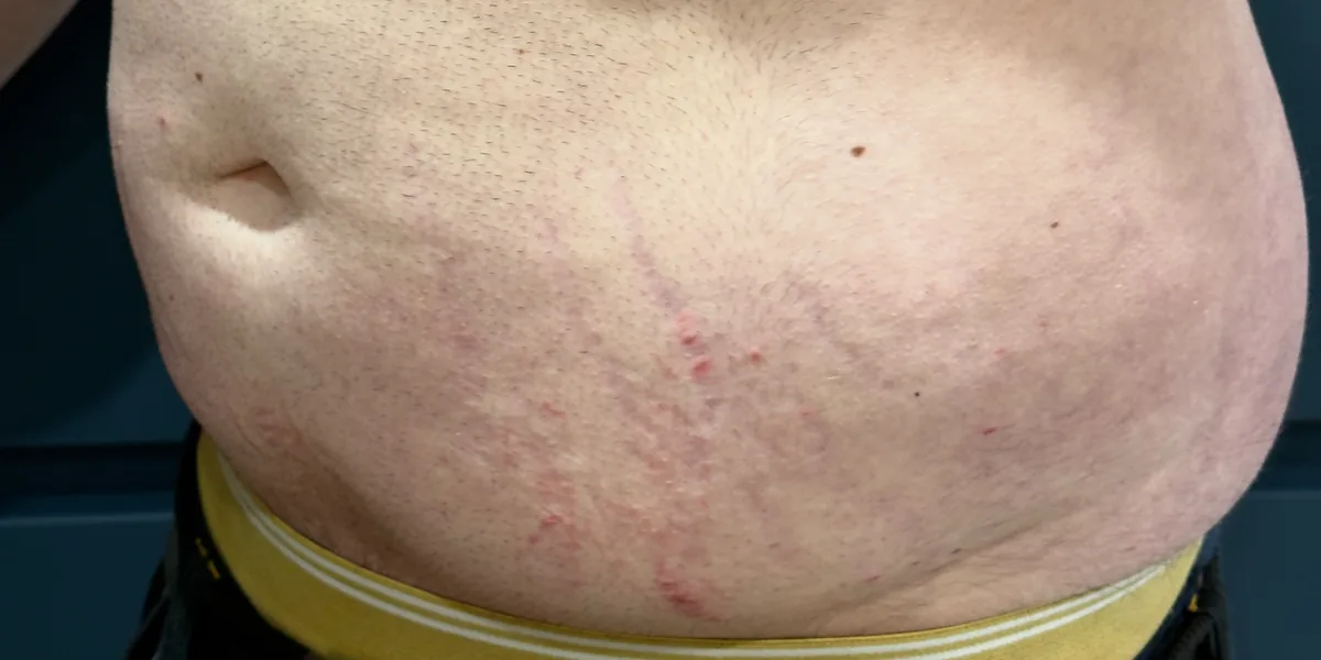 Abdominal stretch marks before Morpheus8 Burst — Rejuvena Clinic Bedford