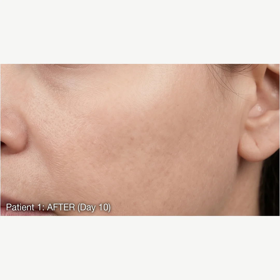 Patient 1 after — chemical peel — Rejuvena Clinic Bedford