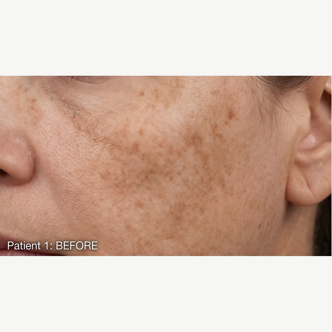 Patient 1 before — chemical peel — Rejuvena Clinic Bedford