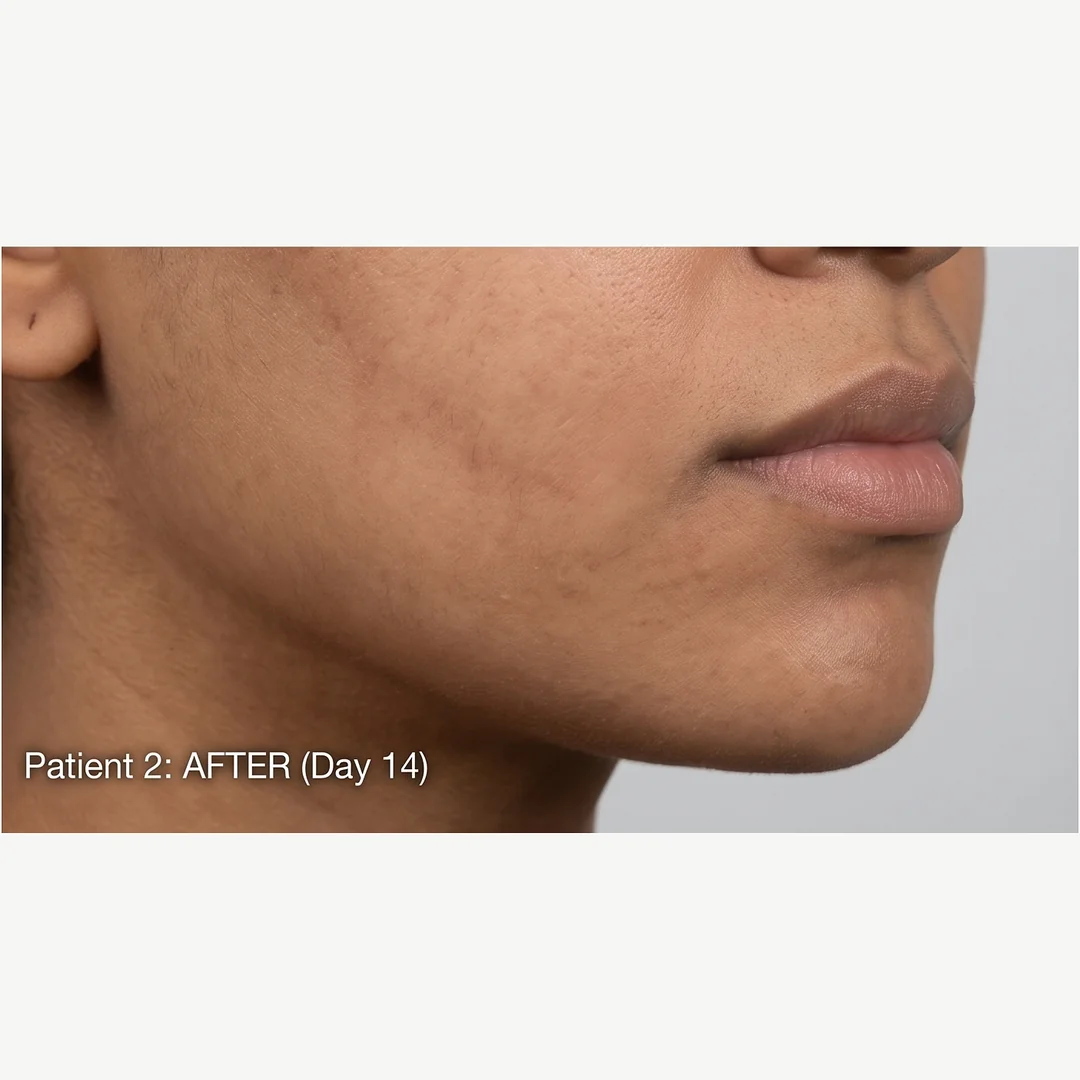 Patient 2 after — chemical peel — Rejuvena Clinic Bedford