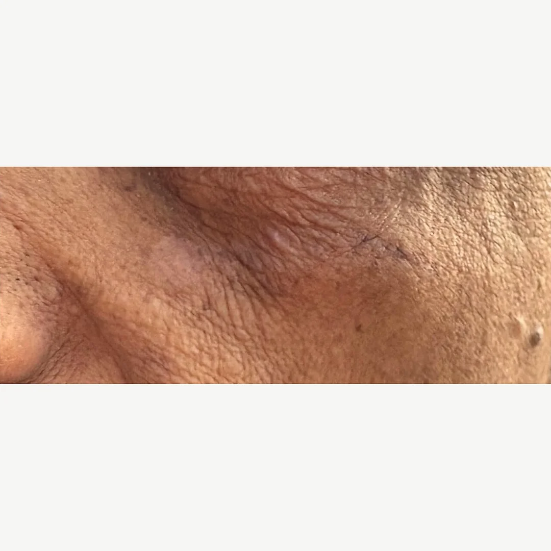 Age spot after — cryotherapy — Rejuvena Clinic Bedford