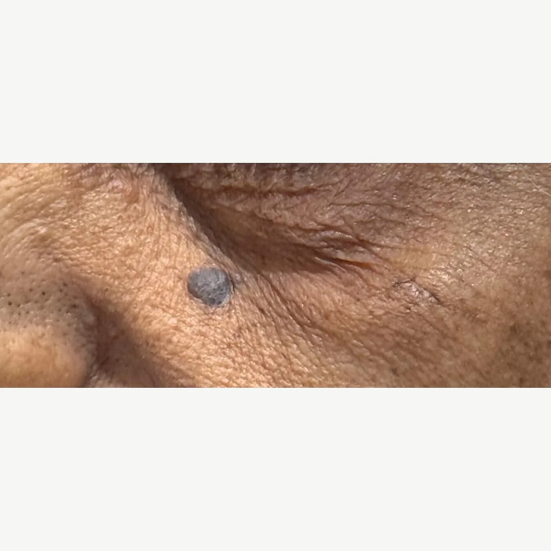 Age spot before — cryotherapy — Rejuvena Clinic Bedford