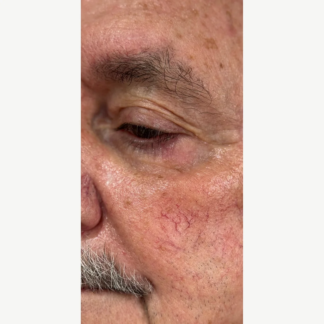 Seborrheic keratosis after — cryotherapy lesion removal — Rejuvena Clinic Bedford