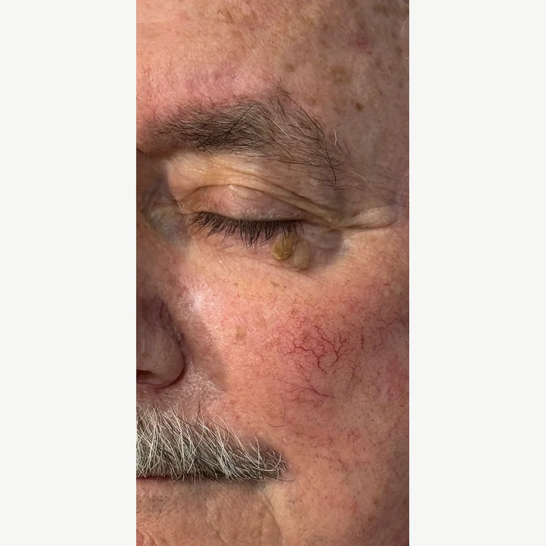 Seborrheic keratosis before — cryotherapy lesion removal — Rejuvena Clinic Bedford