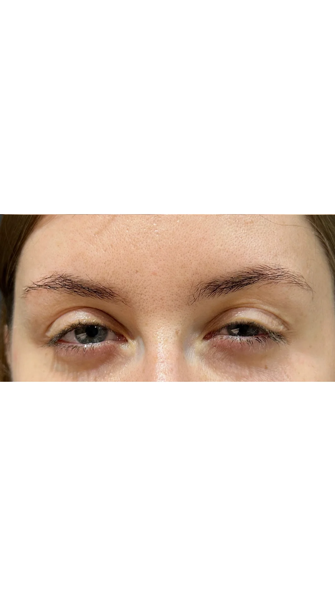 Anti-Wrinkle after — Rejuvena Clinic Bedford
