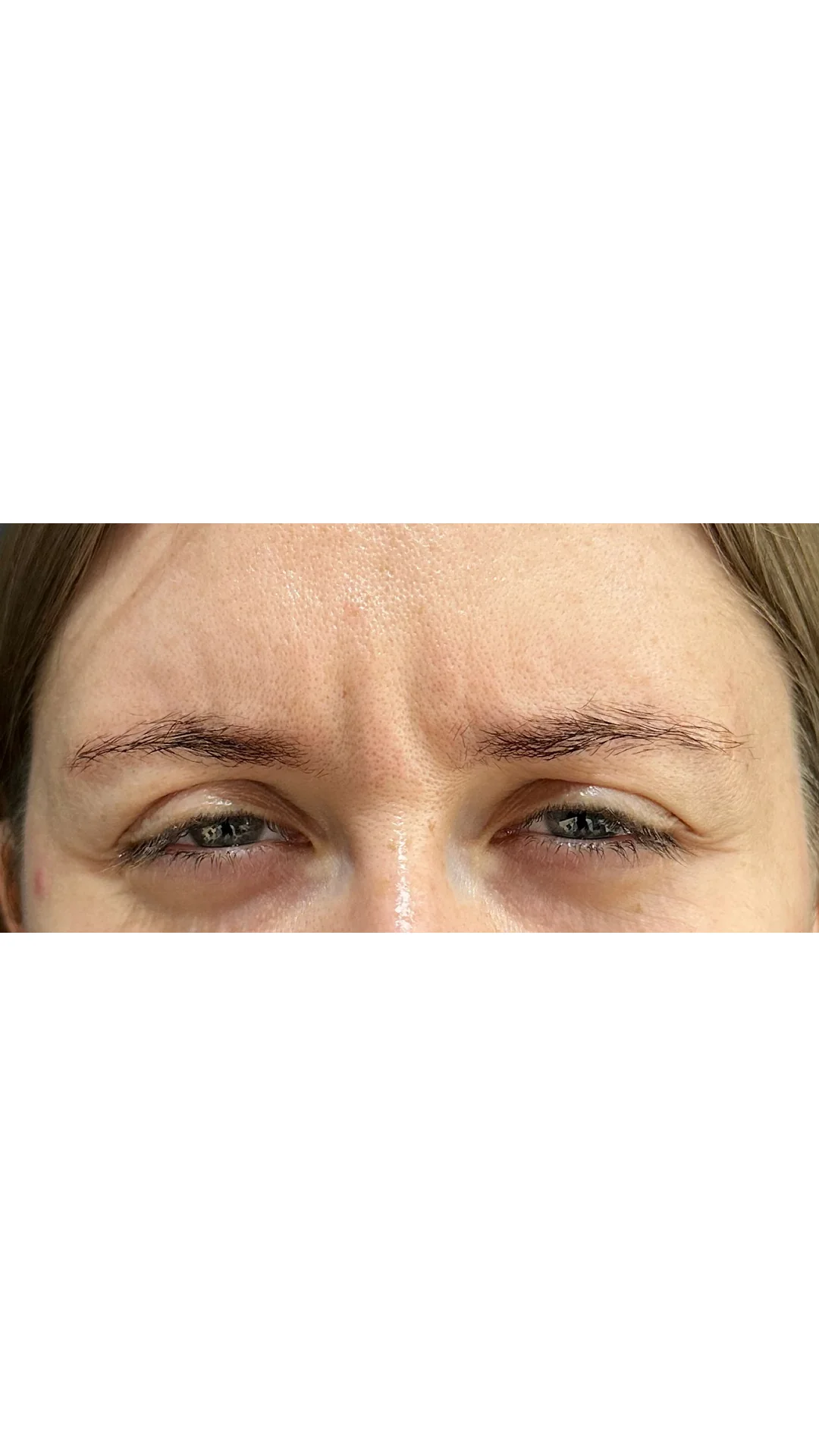 Anti-Wrinkle before — Rejuvena Clinic Bedford