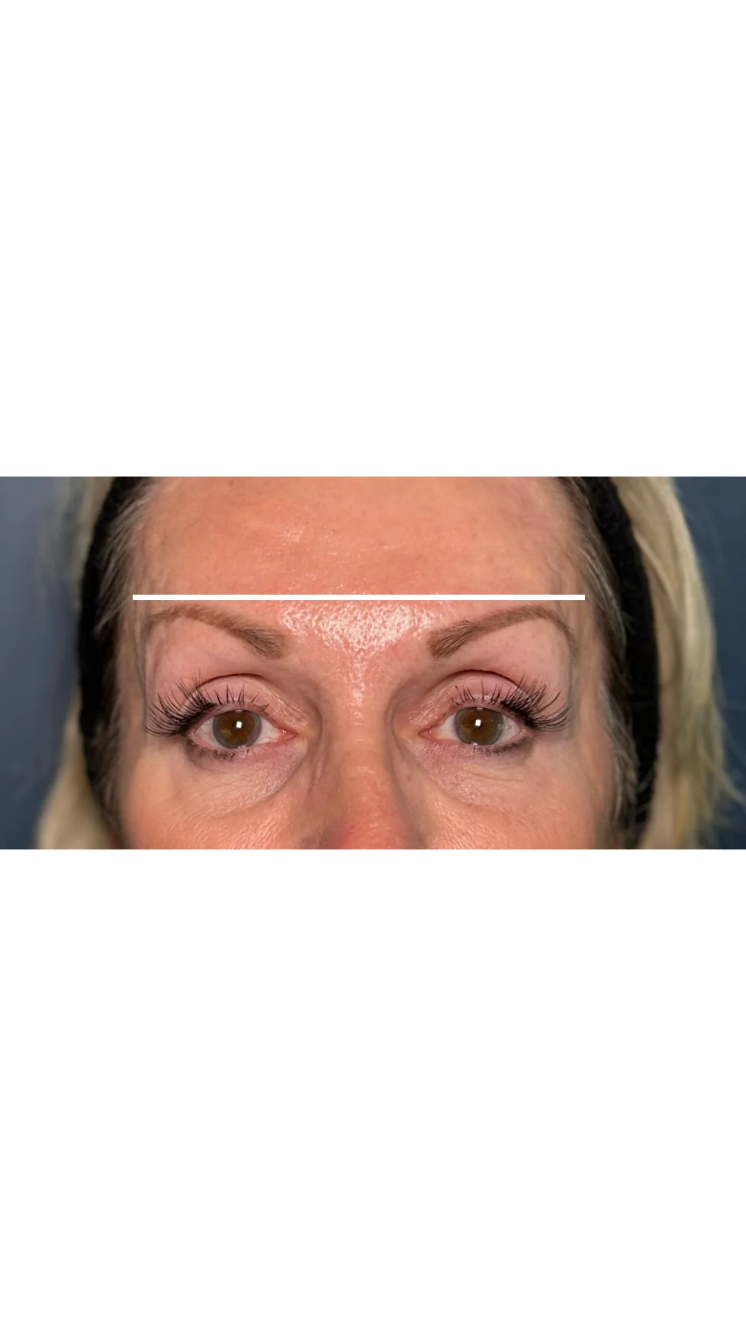 Anti-Wrinkle after — Rejuvena Clinic Bedford