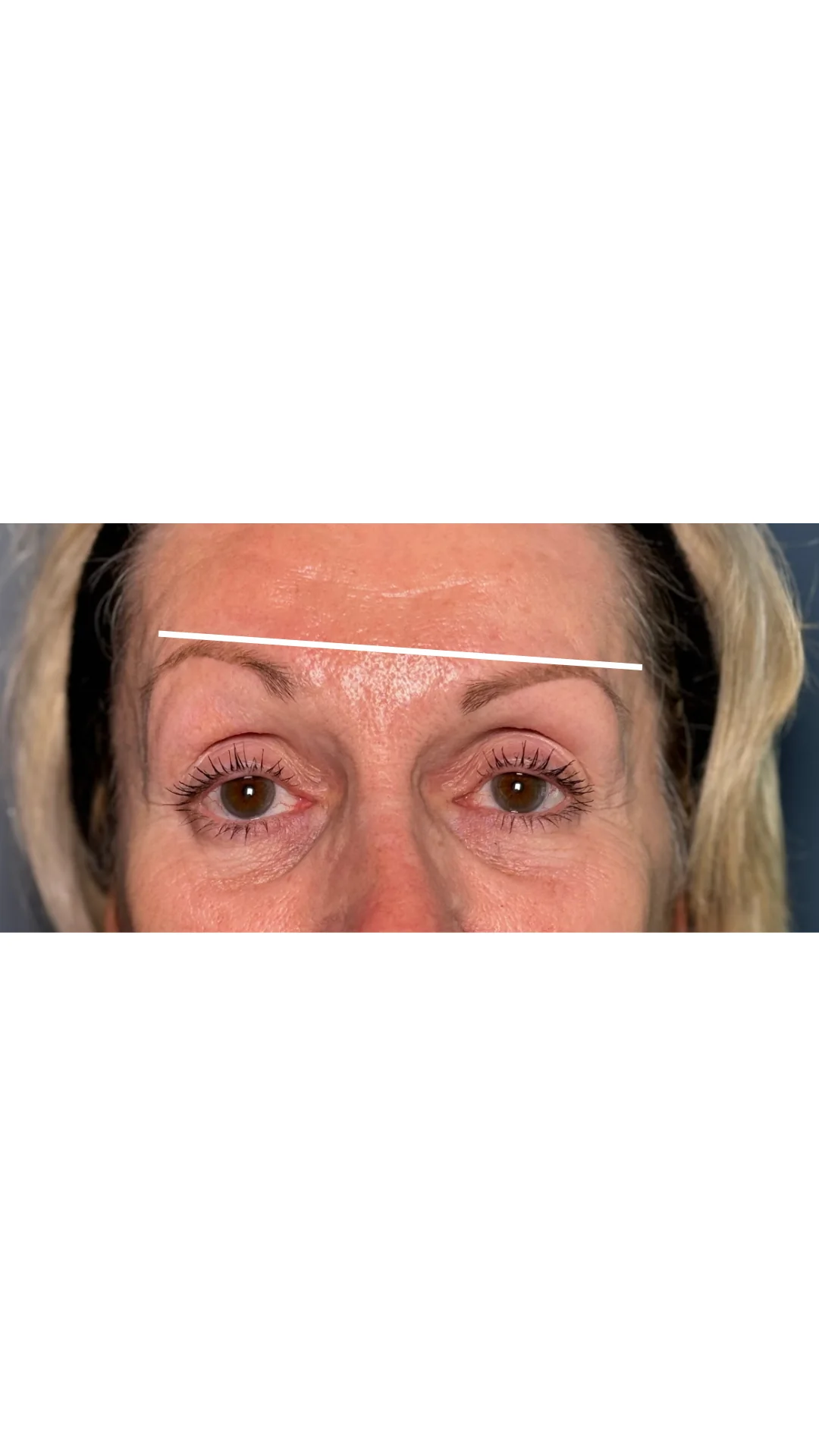 Anti-Wrinkle before — Rejuvena Clinic Bedford