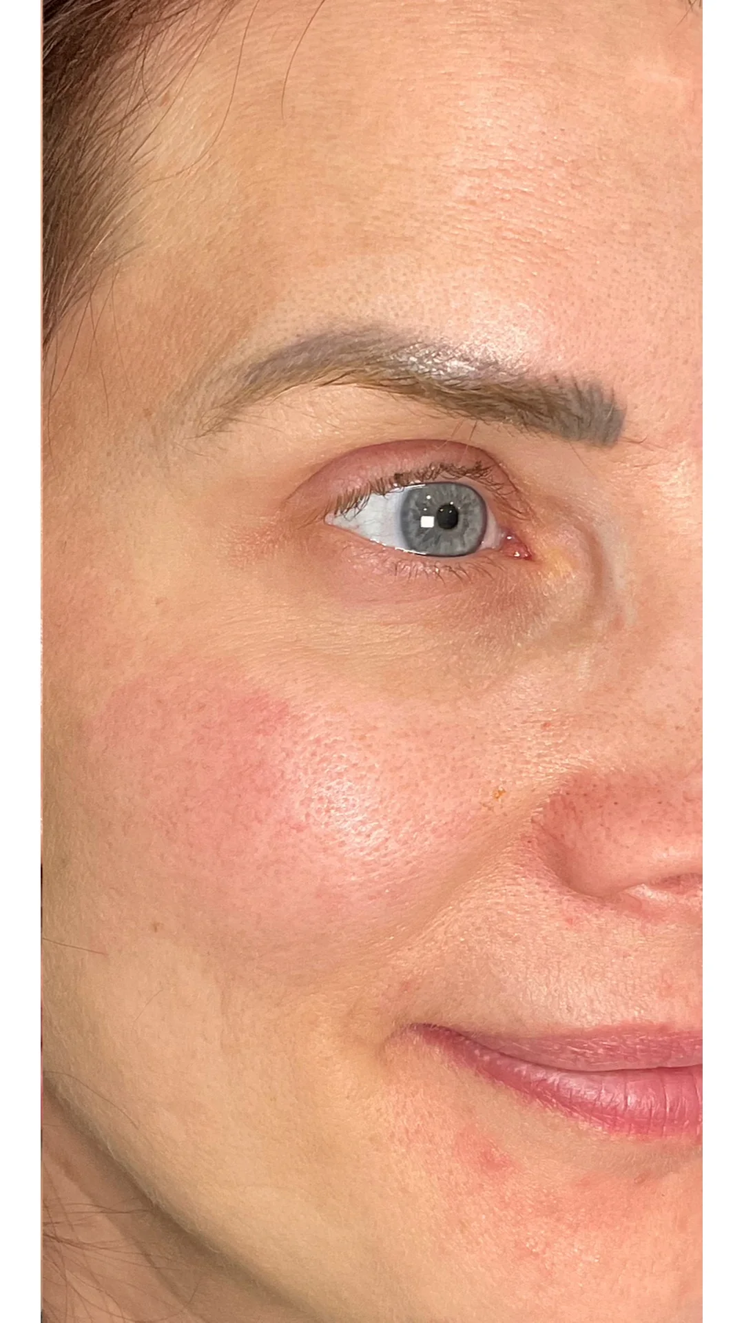 Anti-Wrinkle after — Rejuvena Clinic Bedford