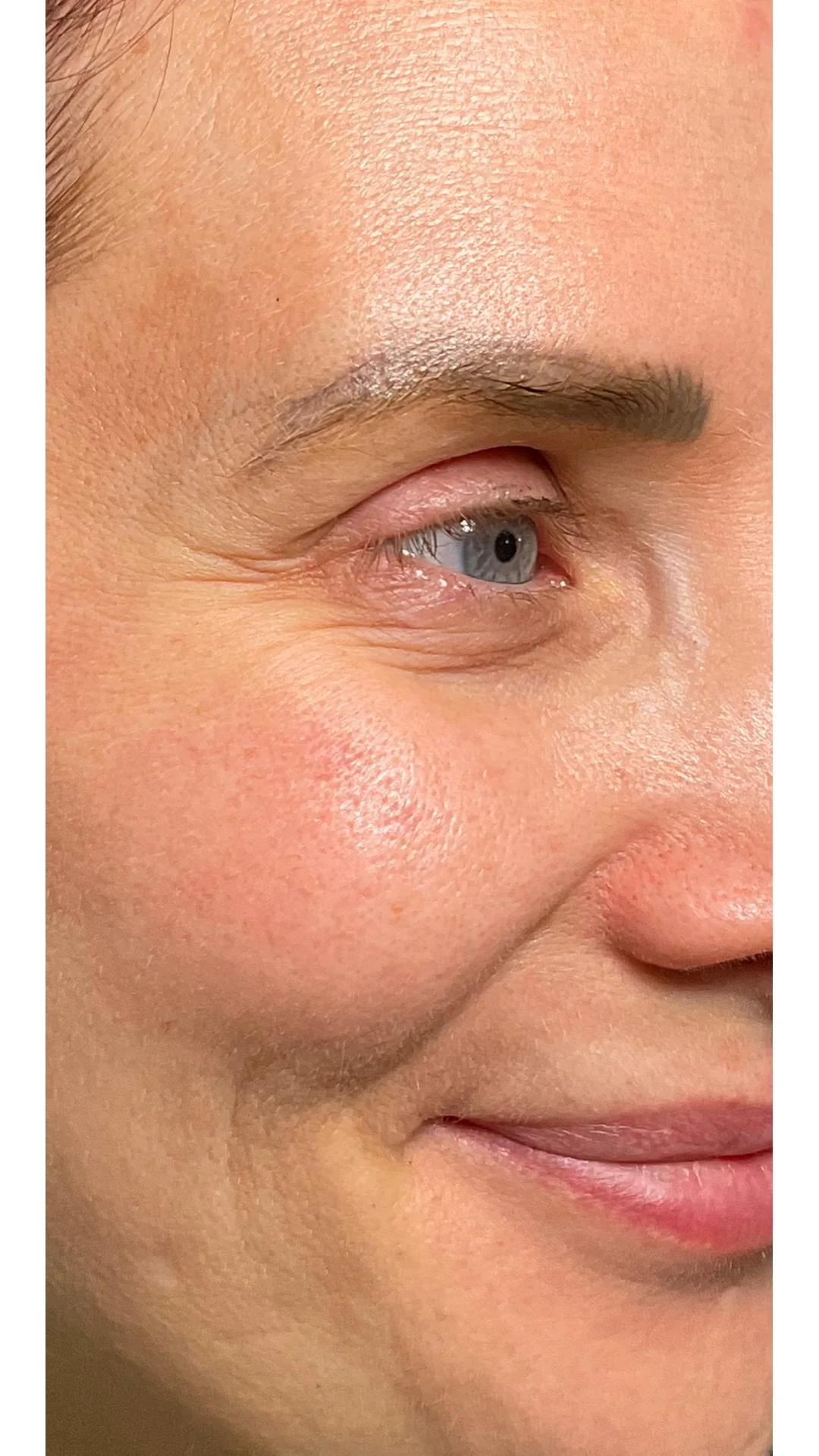 Anti-Wrinkle before — Rejuvena Clinic Bedford