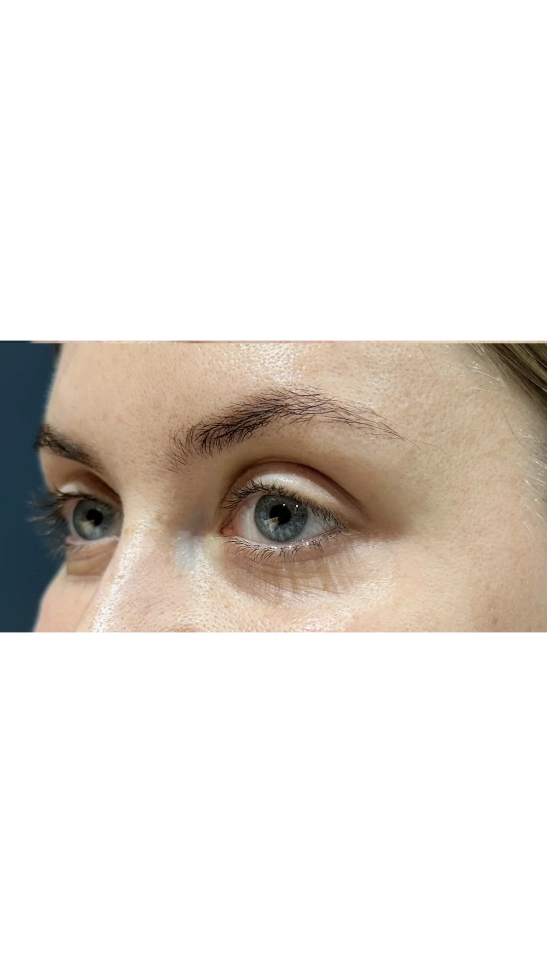 Anti-Wrinkle after — Rejuvena Clinic Bedford
