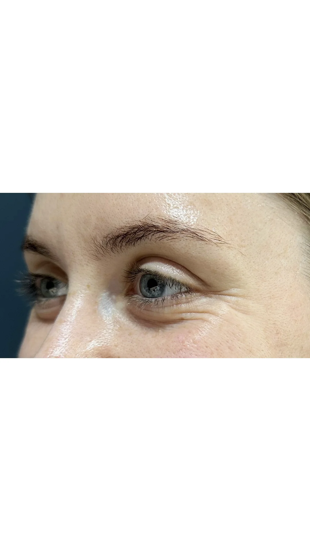 Anti-Wrinkle before — Rejuvena Clinic Bedford