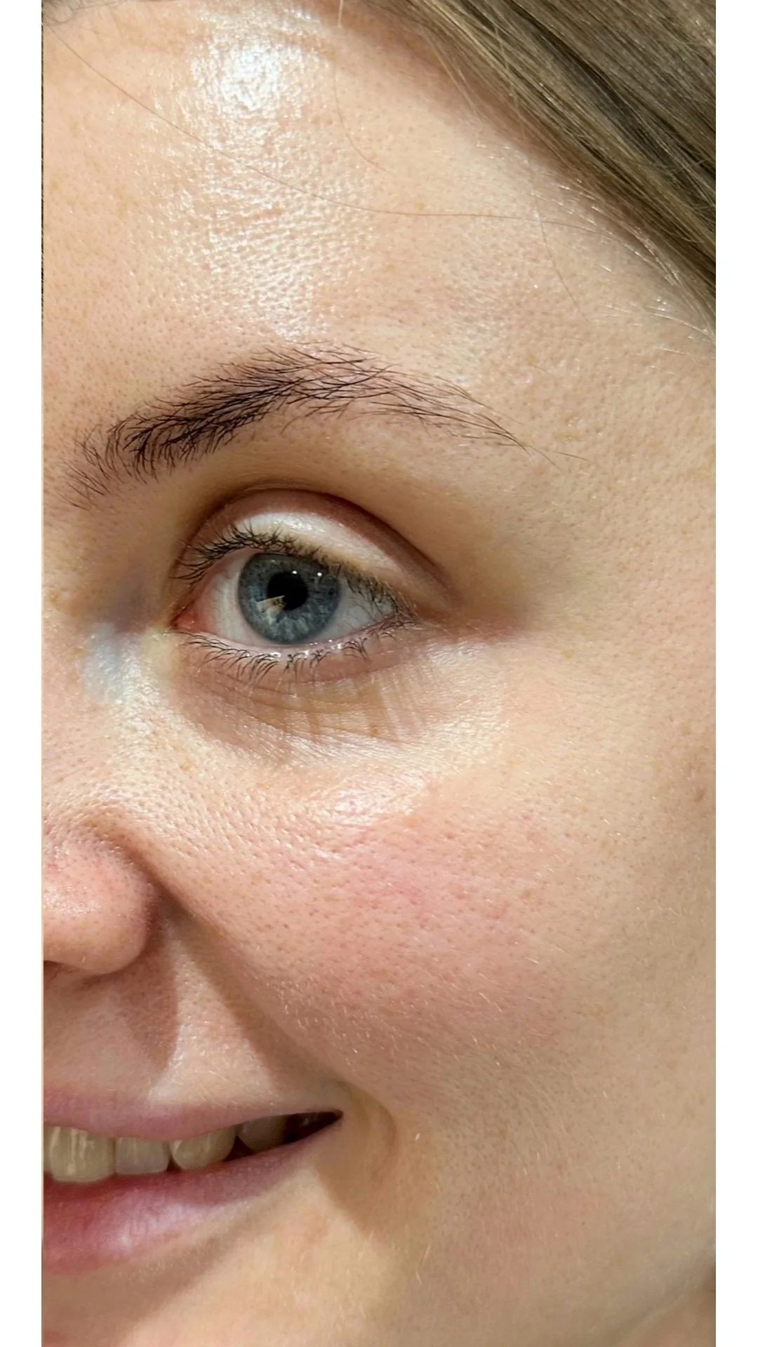 Anti-Wrinkle after — Rejuvena Clinic Bedford