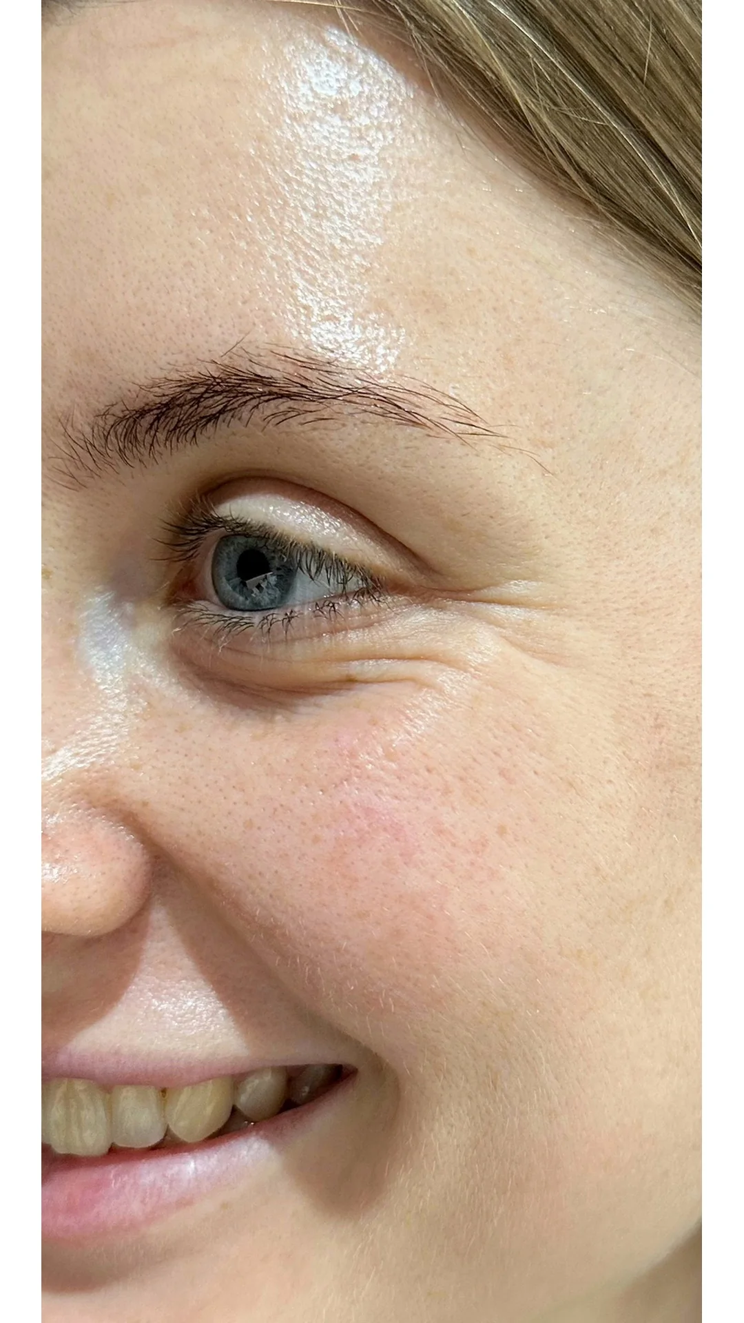 Anti-Wrinkle before — Rejuvena Clinic Bedford