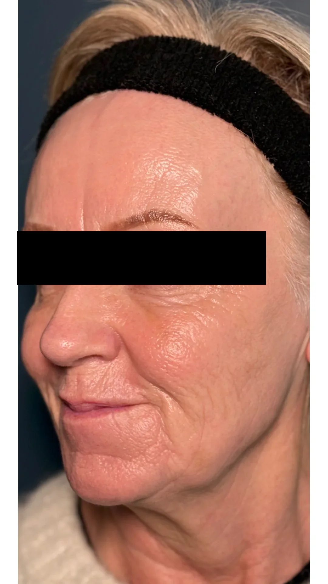 Cool Laser after — Rejuvena Clinic Bedford