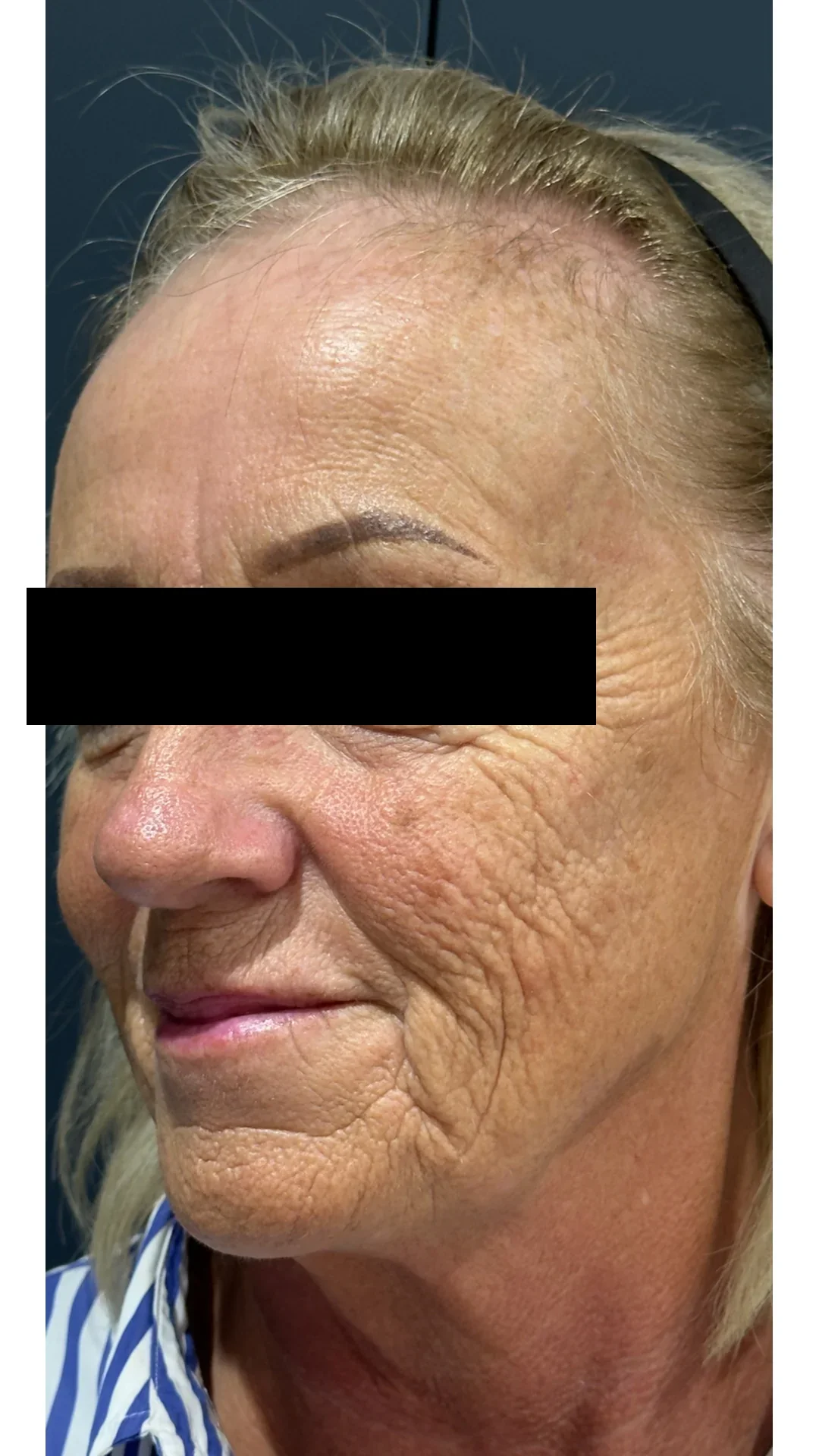 Cool Laser before — Rejuvena Clinic Bedford