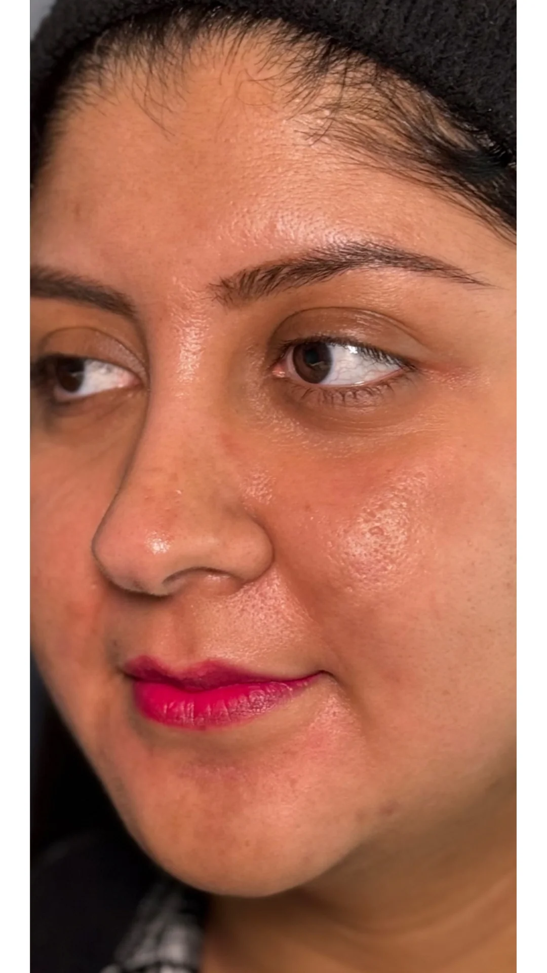 Cosmelan after — Rejuvena Clinic Bedford