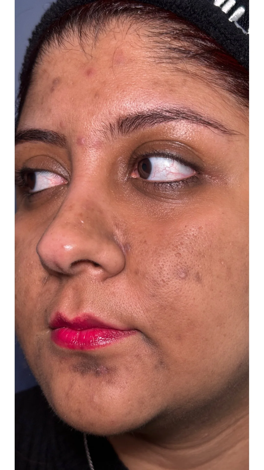 Cosmelan before — Rejuvena Clinic Bedford