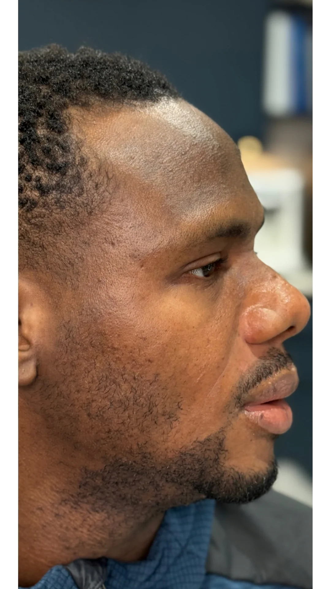 Cosmelan after — Rejuvena Clinic Bedford