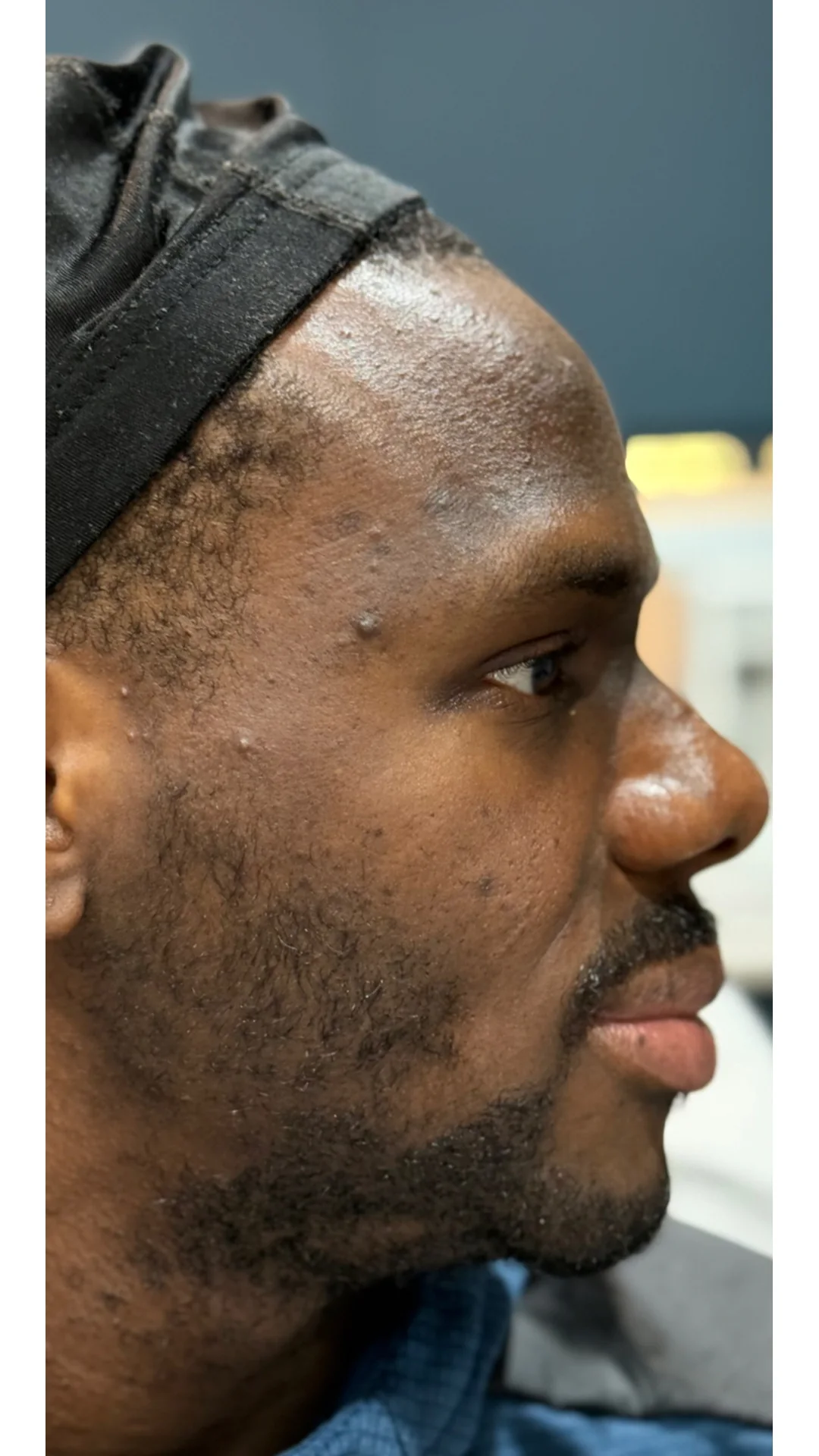 Cosmelan before — Rejuvena Clinic Bedford