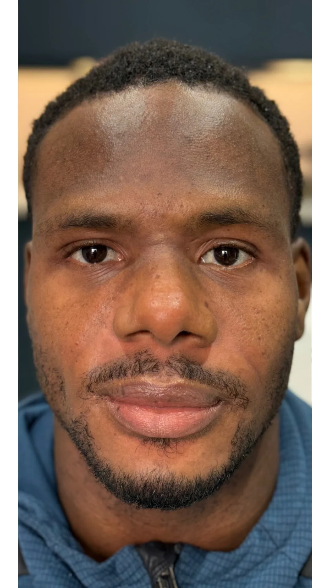 Cosmelan after — Rejuvena Clinic Bedford