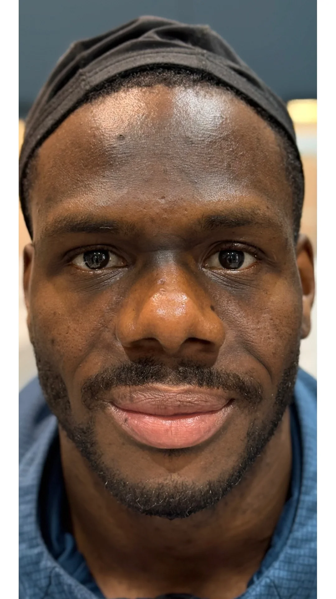 Cosmelan before — Rejuvena Clinic Bedford