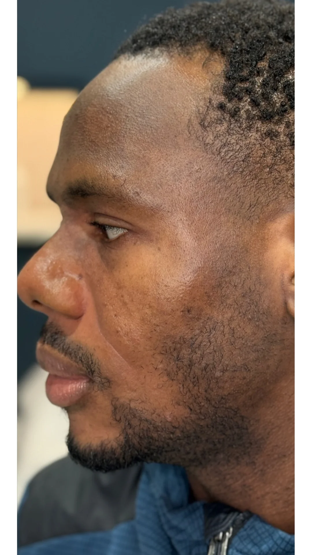 Cosmelan after — Rejuvena Clinic Bedford