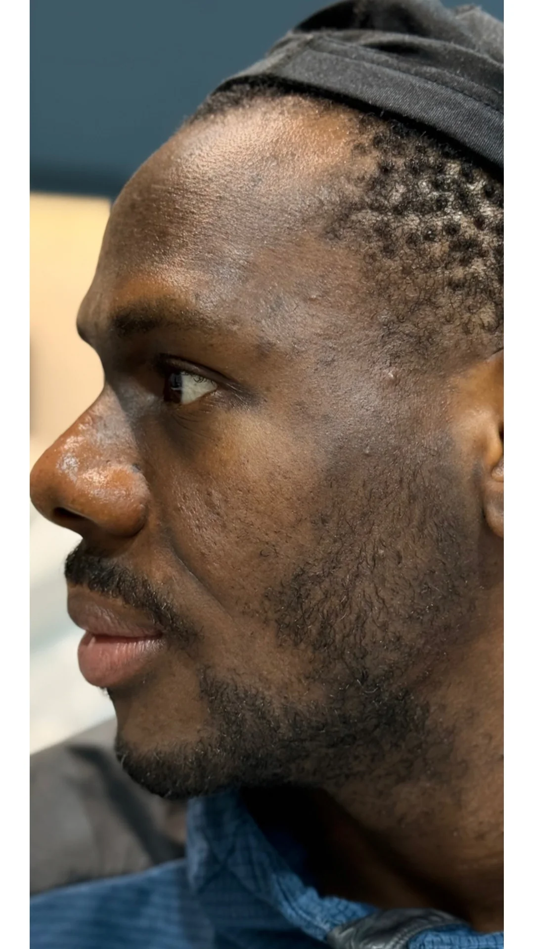 Cosmelan before — Rejuvena Clinic Bedford