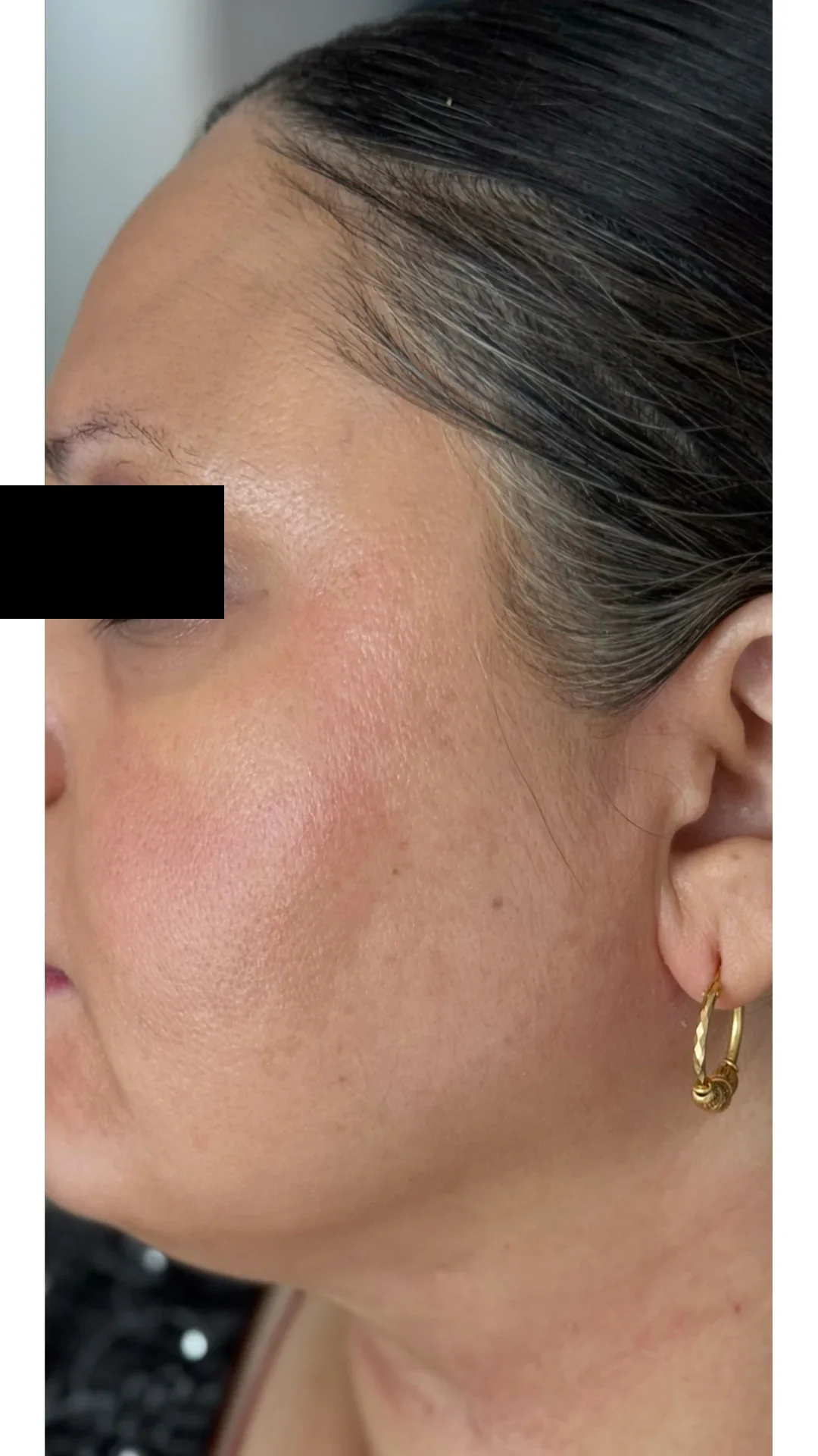 Cosmelan after — Rejuvena Clinic Bedford