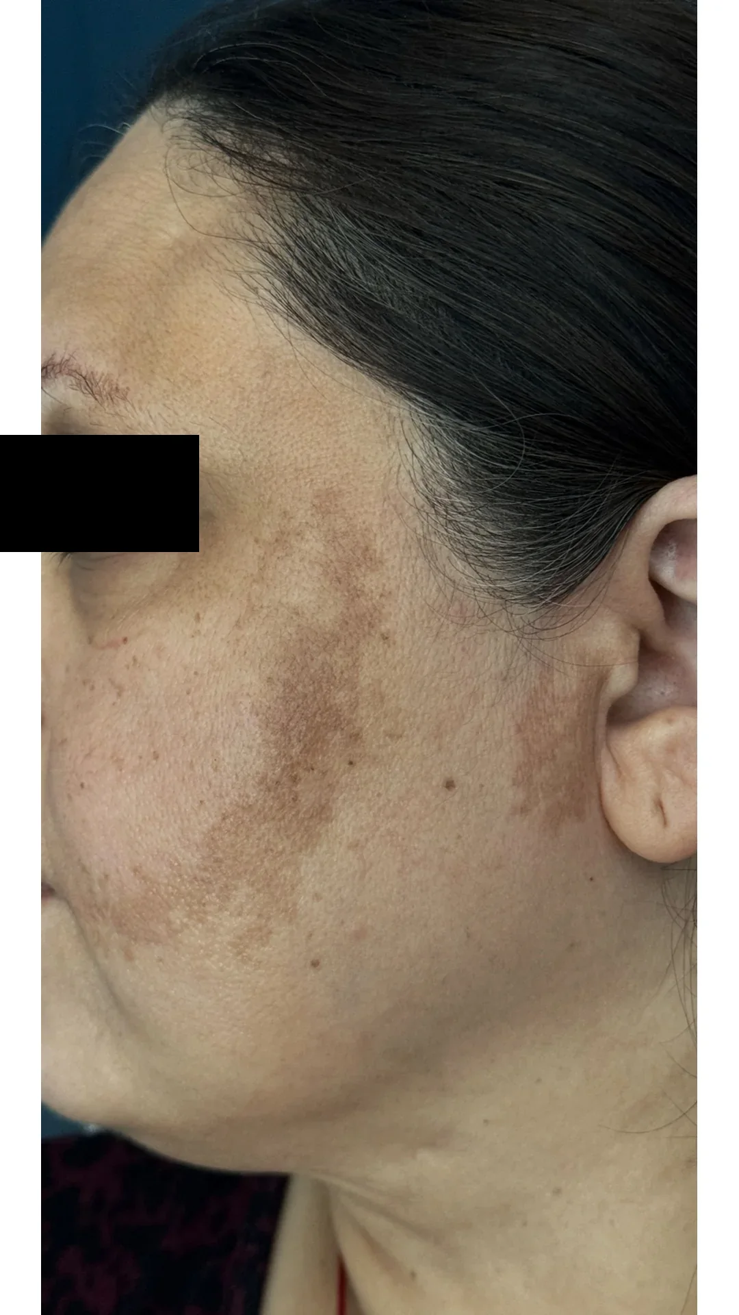 Cosmelan before — Rejuvena Clinic Bedford