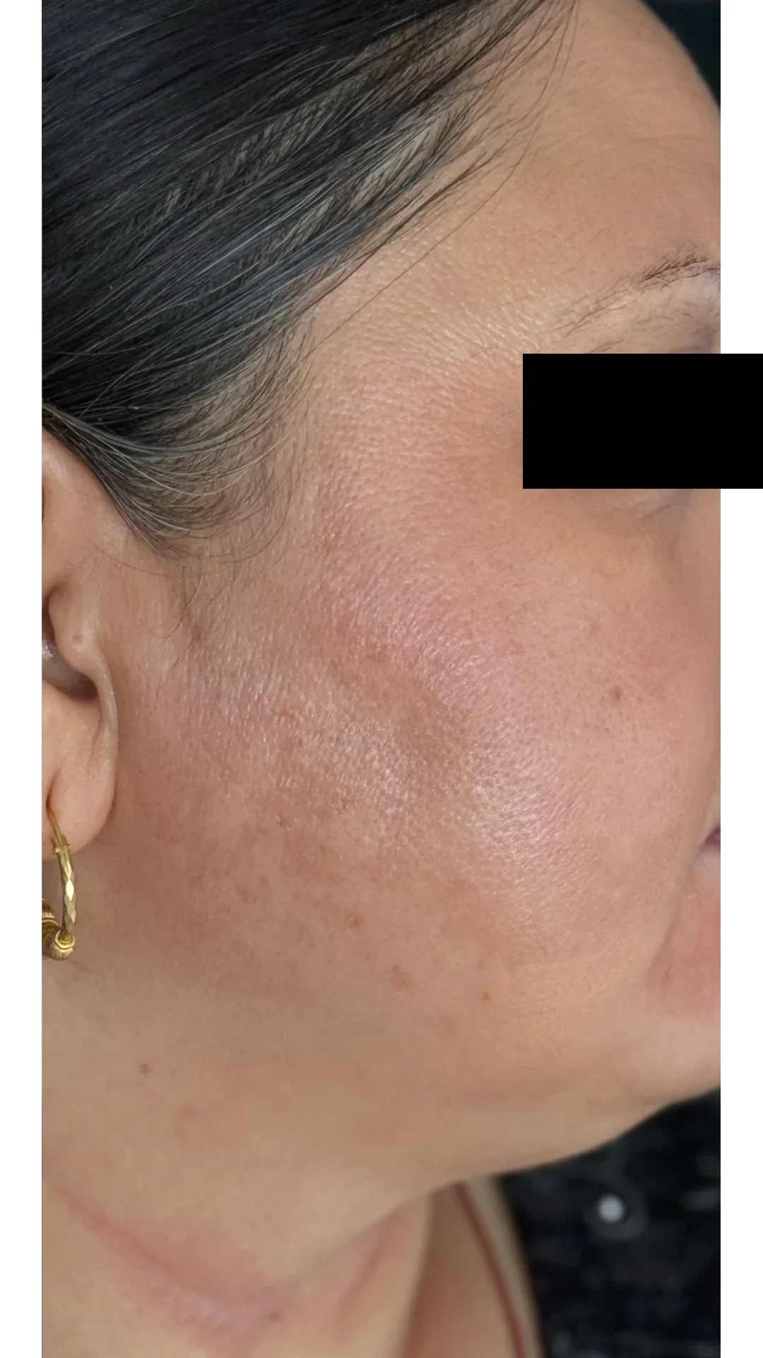 Cosmelan after — Rejuvena Clinic Bedford