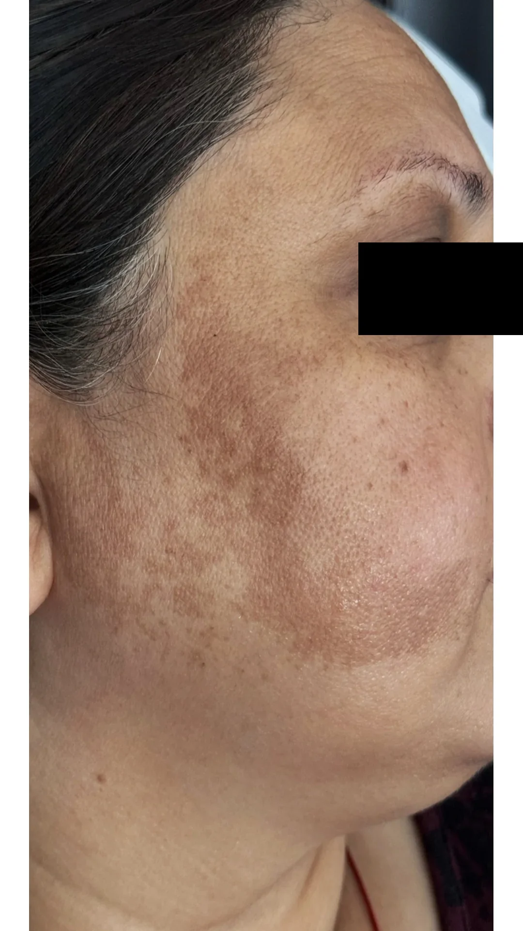 Cosmelan before — Rejuvena Clinic Bedford