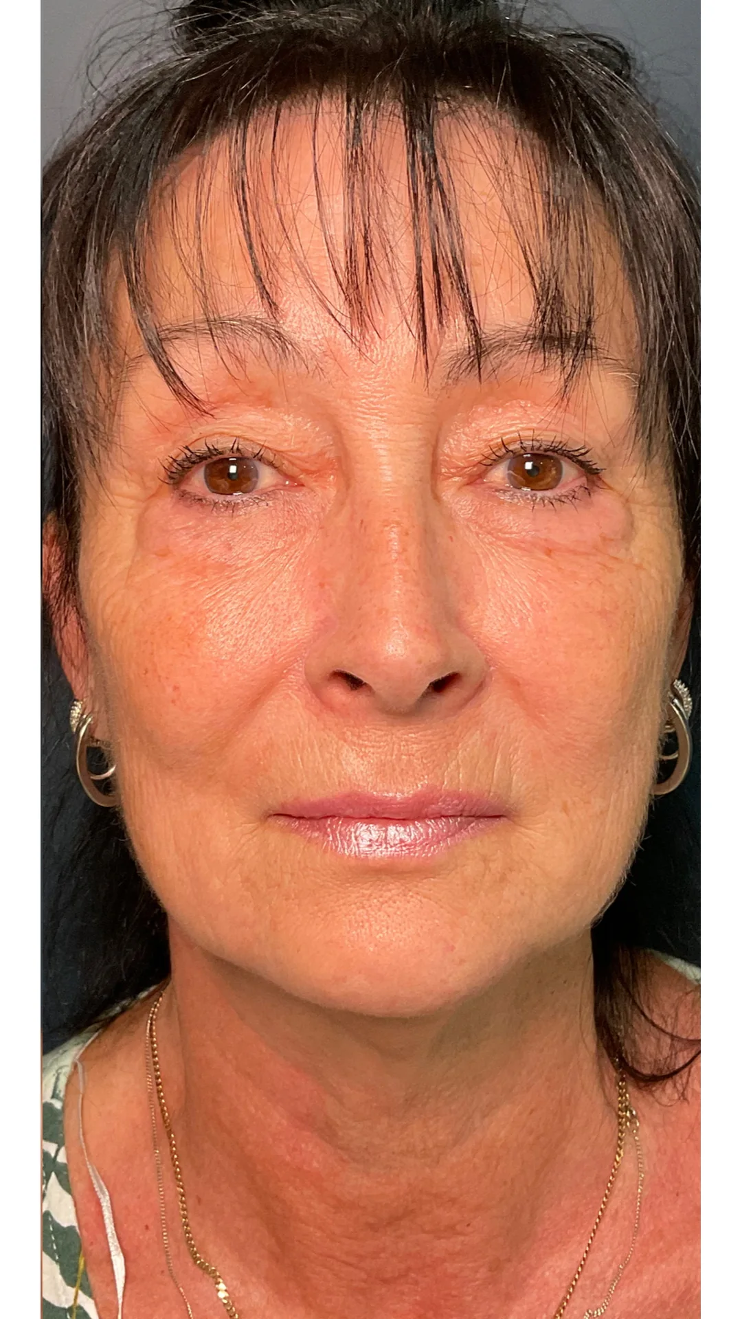 Dermal Fillers after — Rejuvena Clinic Bedford
