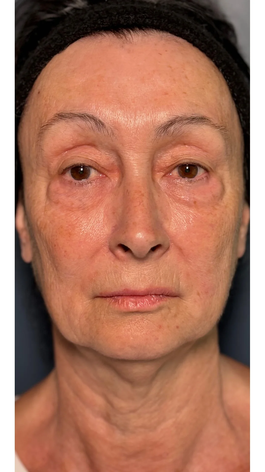 Dermal Fillers before — Rejuvena Clinic Bedford