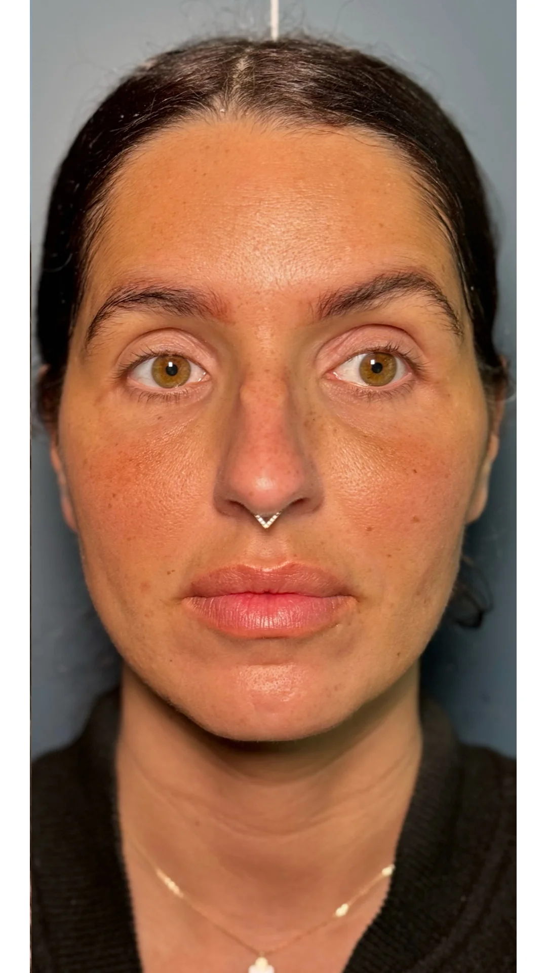 Dermal Fillers after — Rejuvena Clinic Bedford