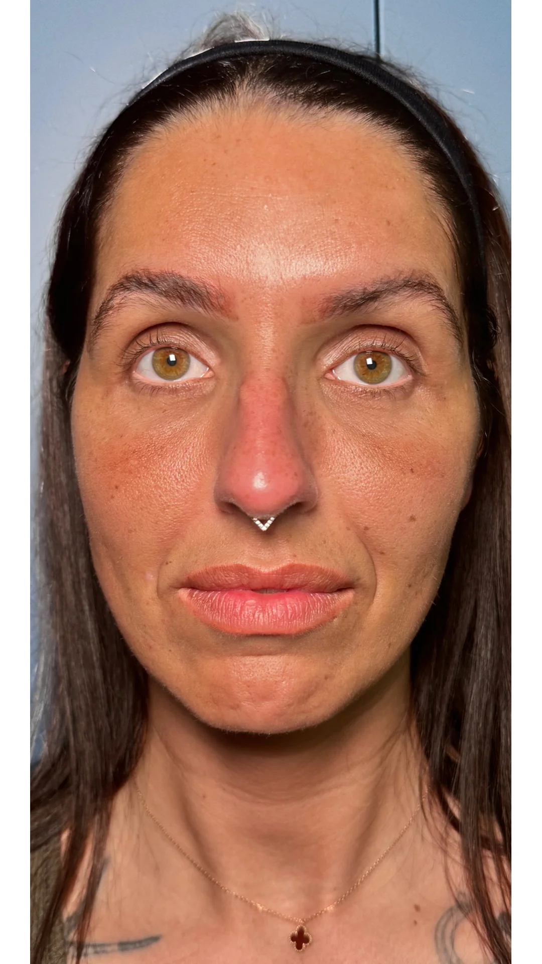 Dermal Fillers before — Rejuvena Clinic Bedford