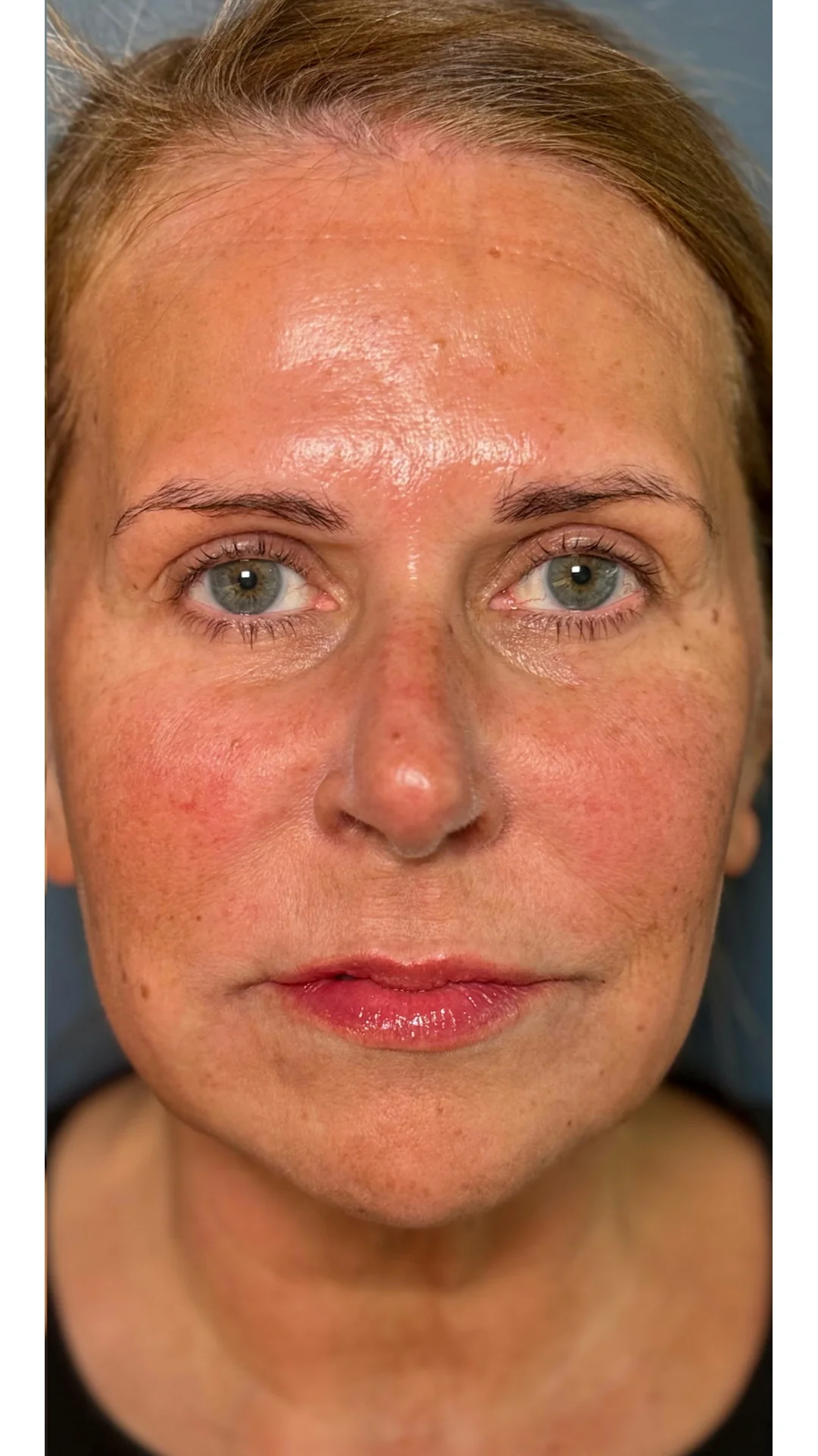 Dermal Fillers after — Rejuvena Clinic Bedford