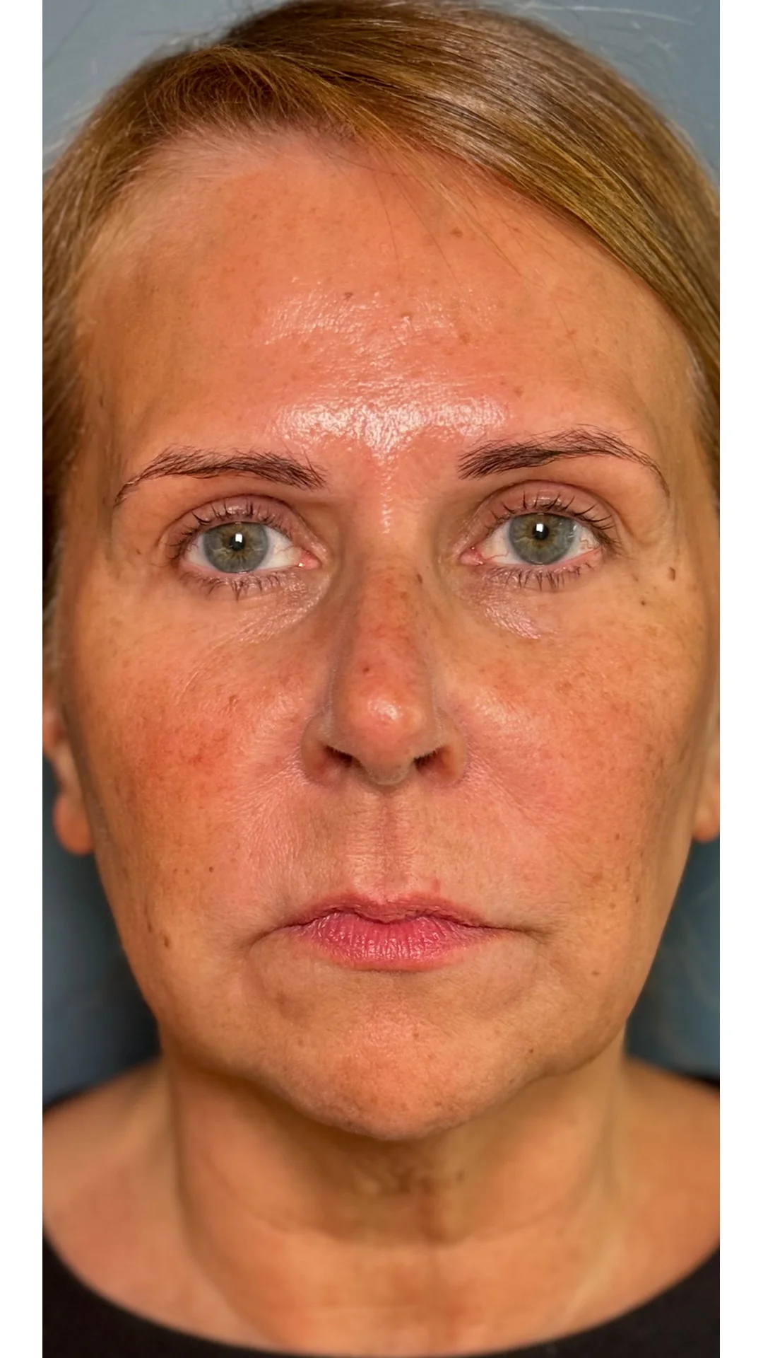 Dermal Fillers before — Rejuvena Clinic Bedford