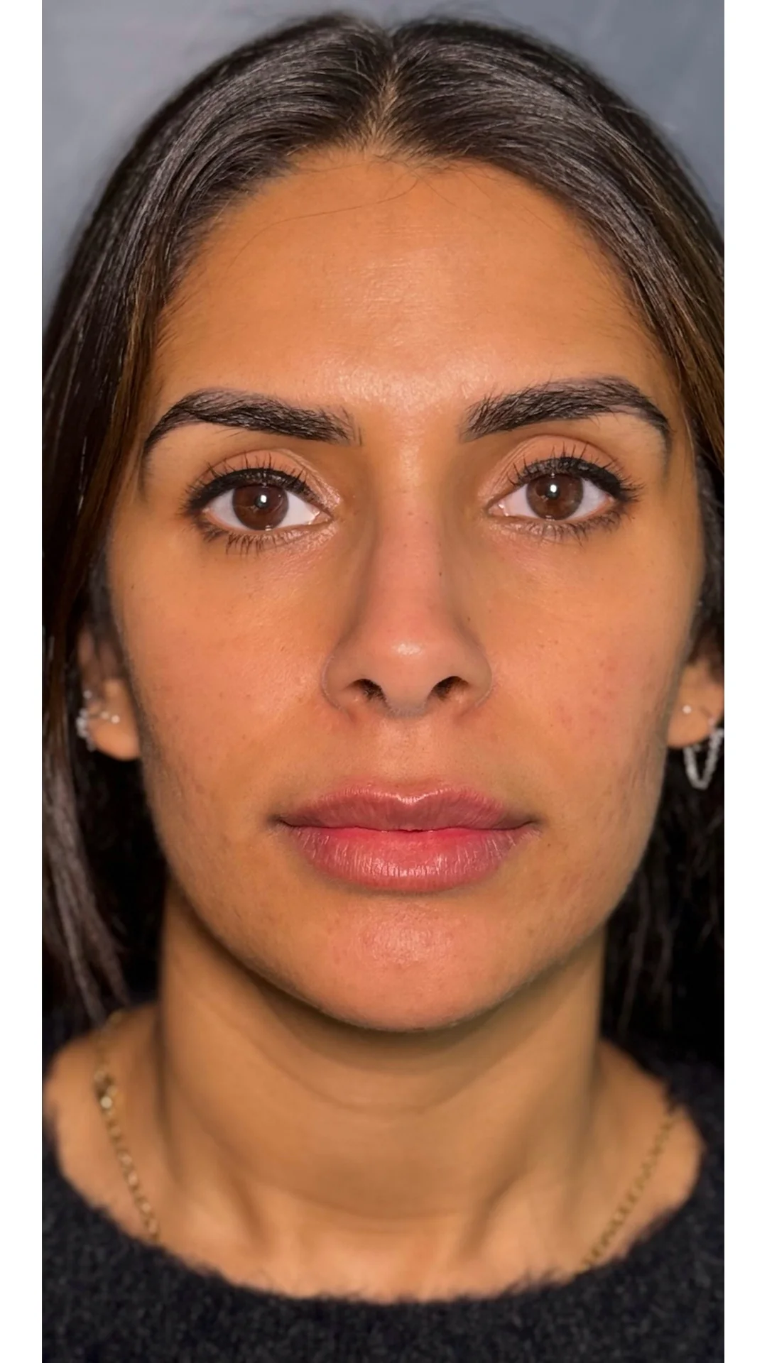 Dermal Fillers after — Rejuvena Clinic Bedford