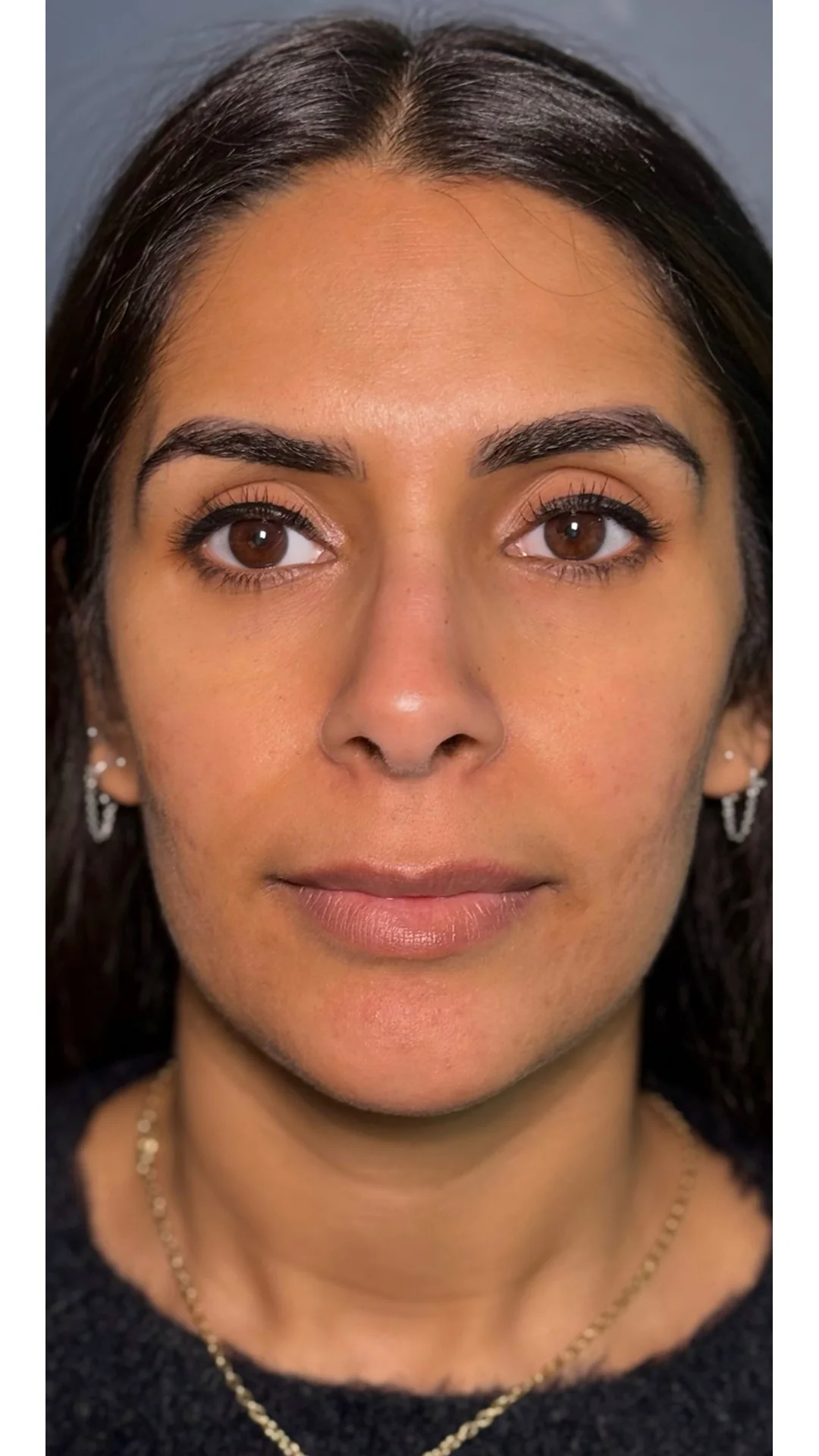 Dermal Fillers before — Rejuvena Clinic Bedford