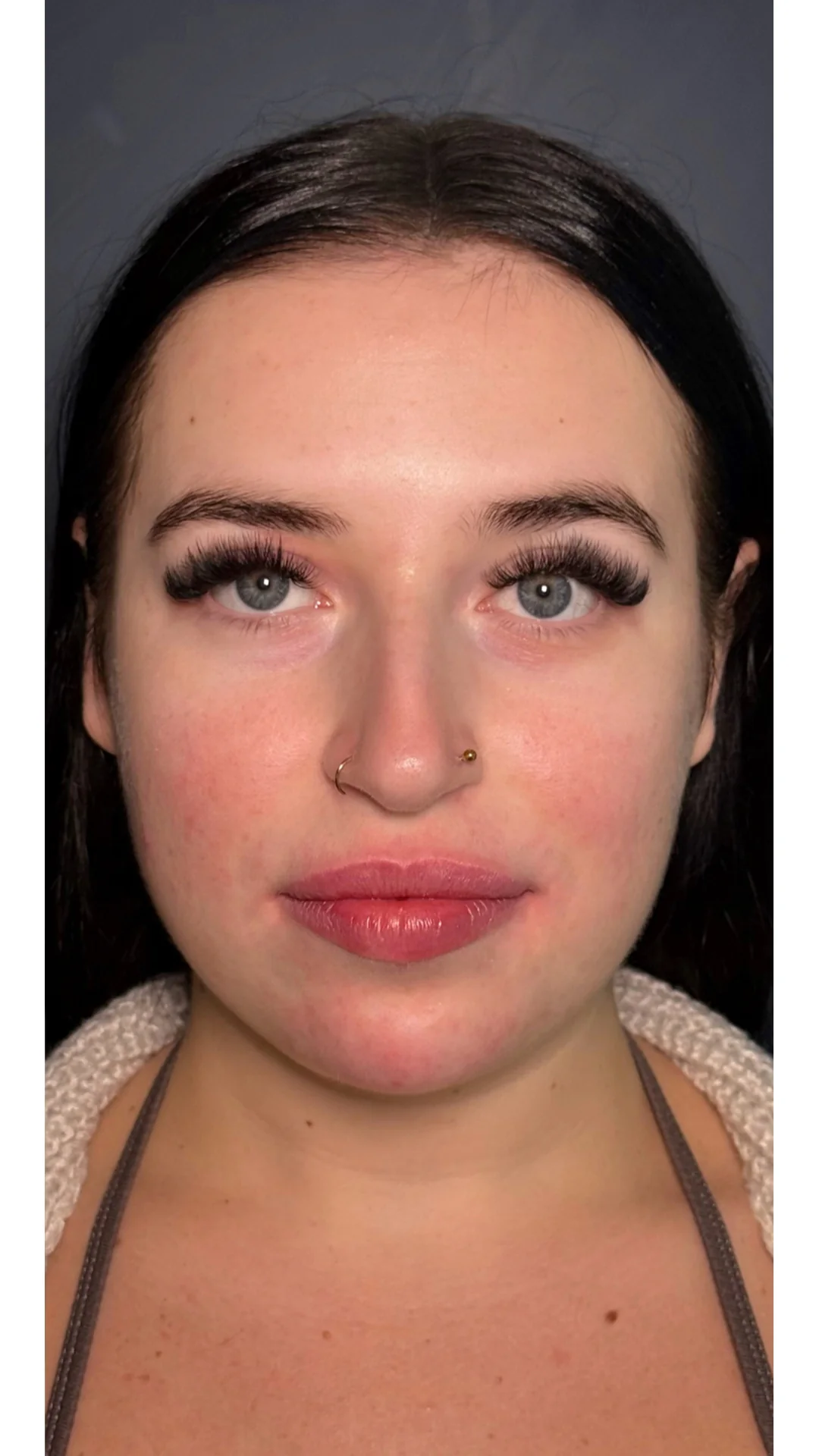 Dermal Fillers after — Rejuvena Clinic Bedford