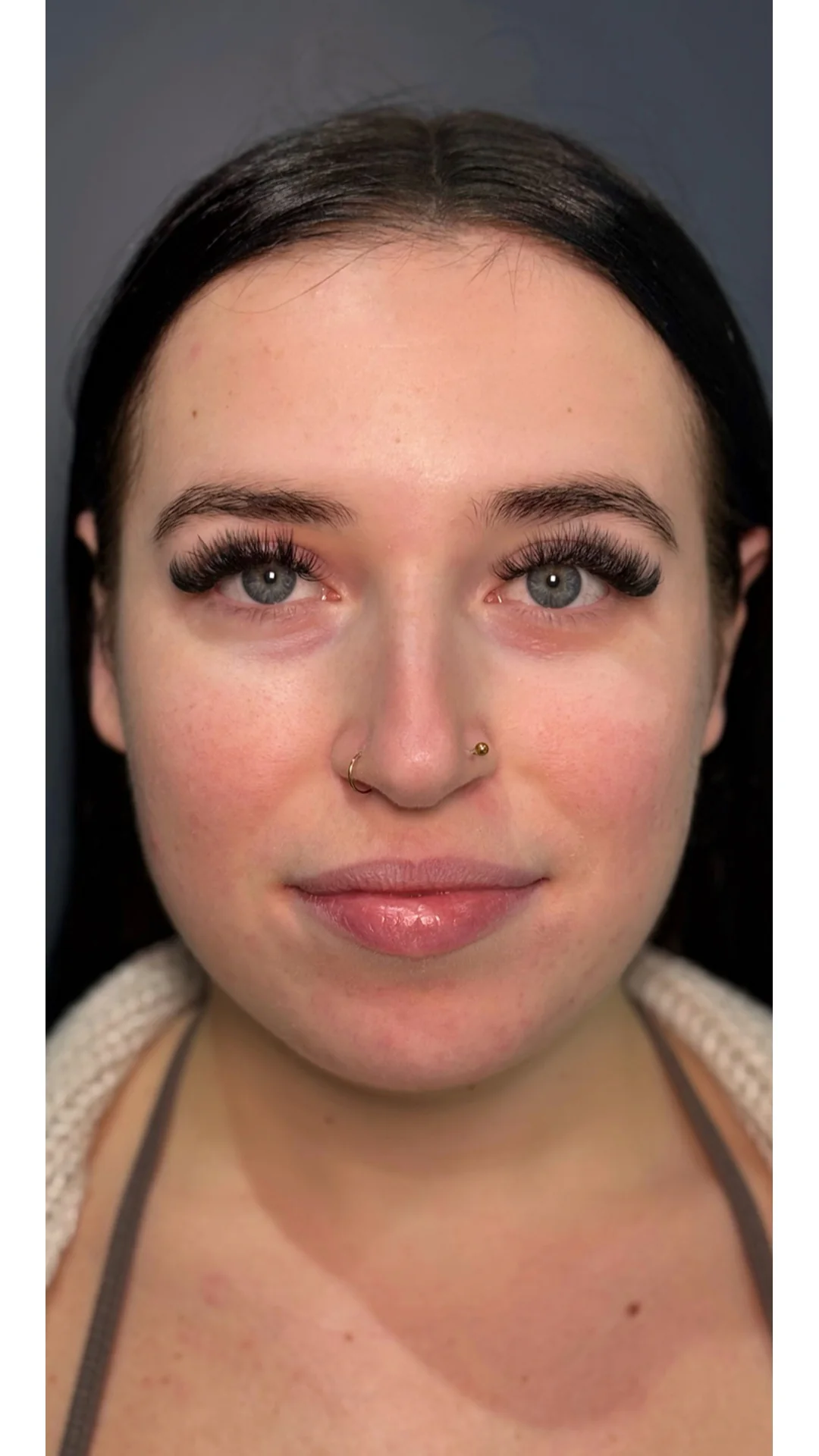 Dermal Fillers before — Rejuvena Clinic Bedford