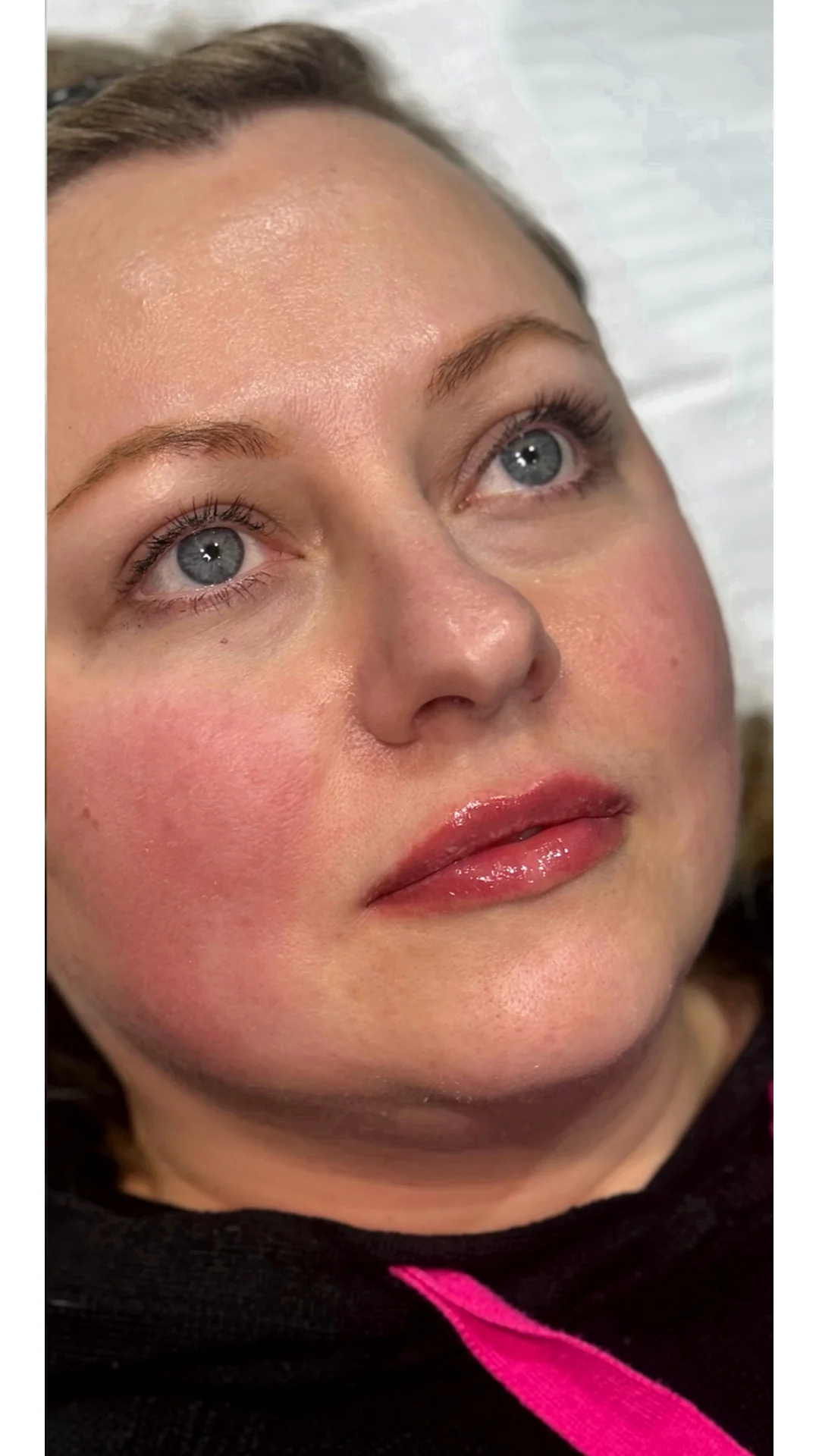 Dermal Fillers after — Rejuvena Clinic Bedford