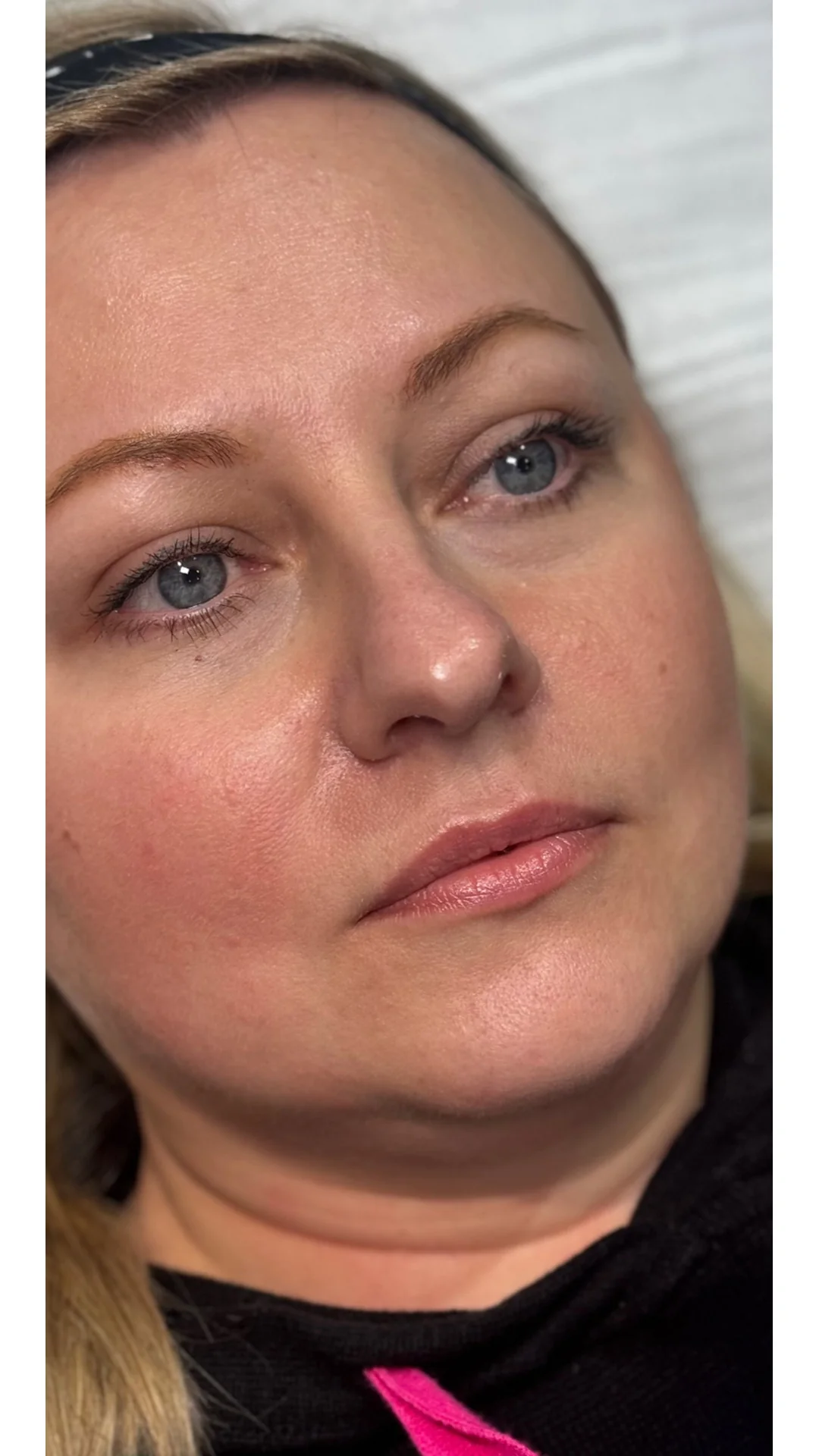 Dermal Fillers before — Rejuvena Clinic Bedford