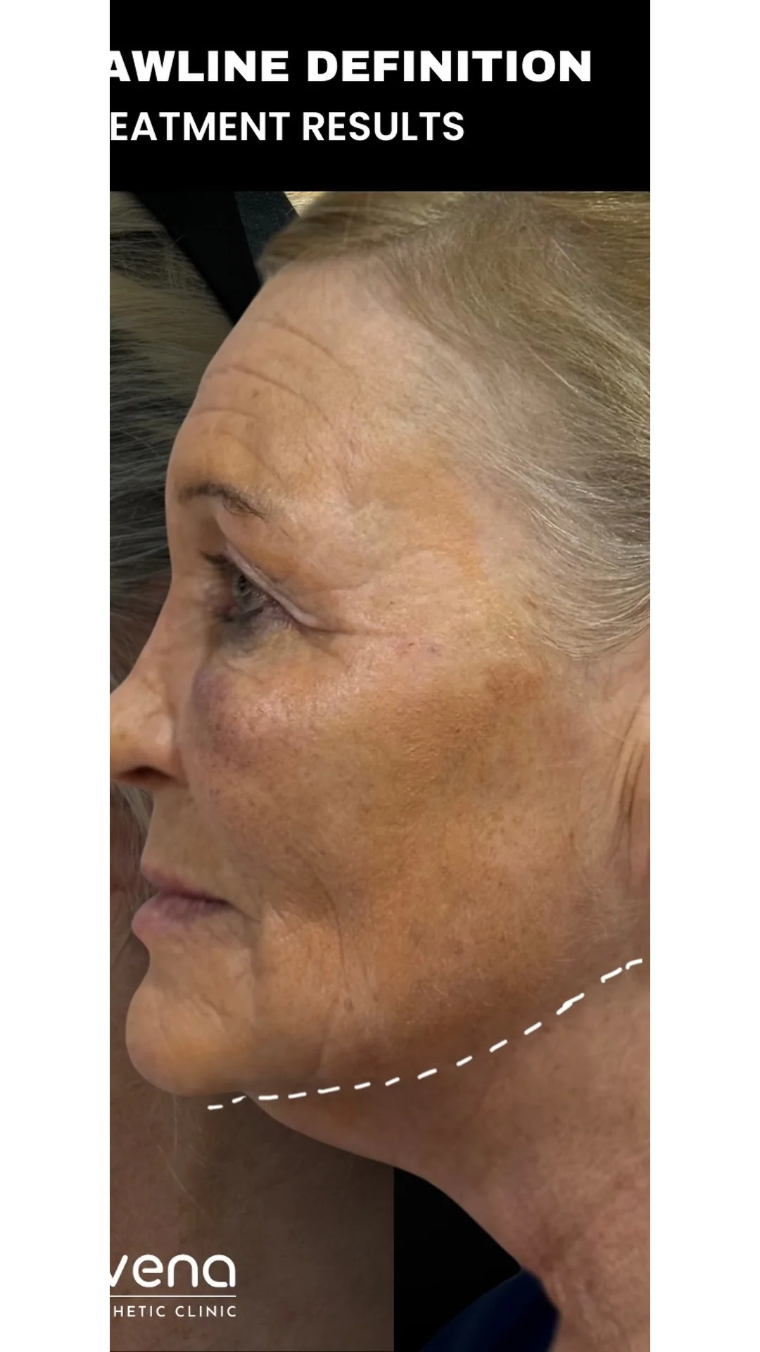 EndoContour after — Rejuvena Clinic Bedford