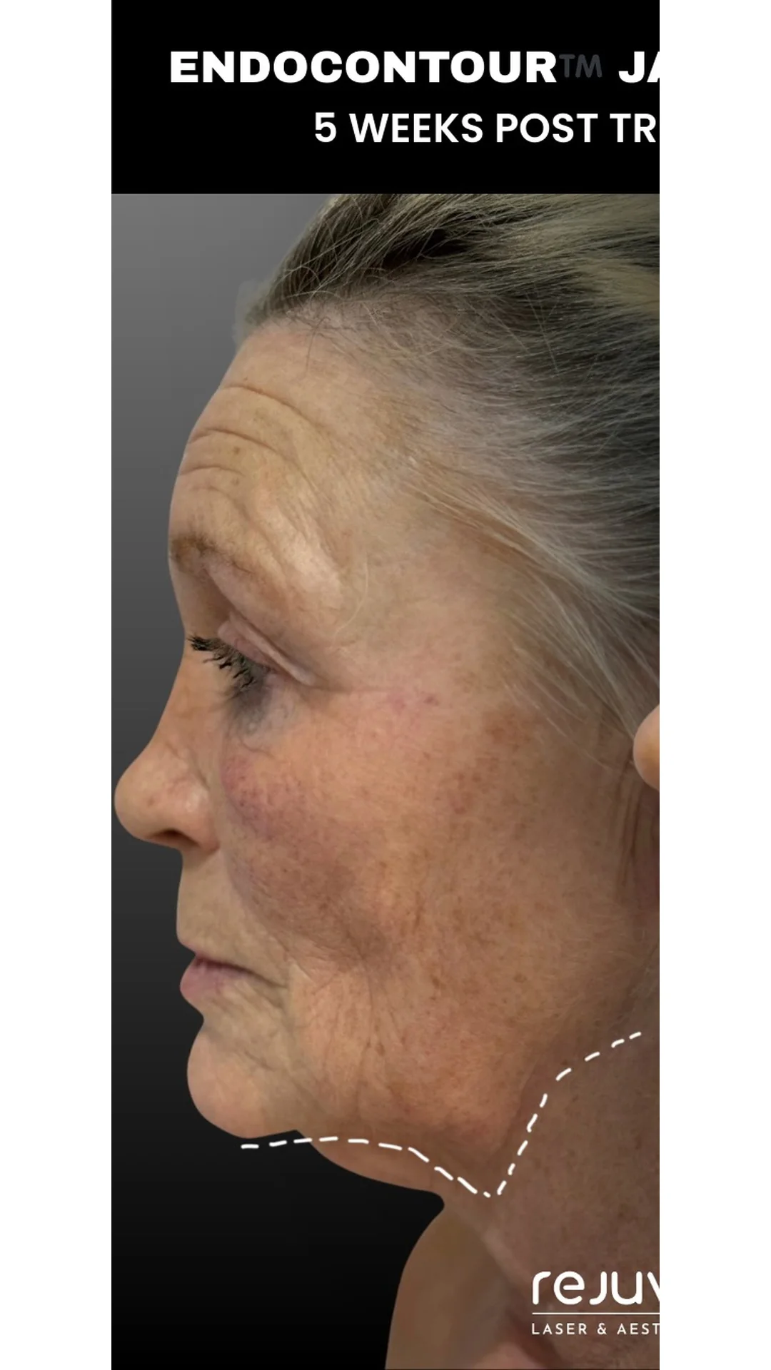 EndoContour before — Rejuvena Clinic Bedford