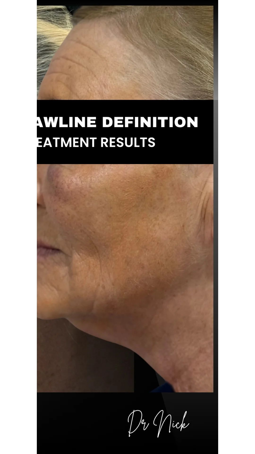 EndoContour after — Rejuvena Clinic Bedford