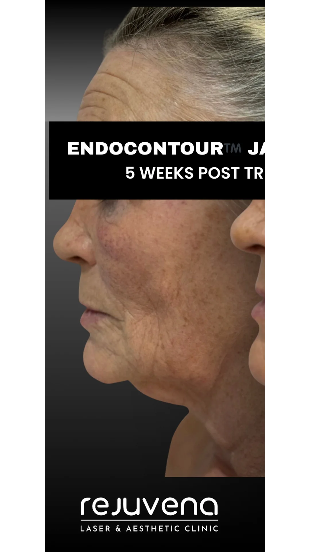 EndoContour before — Rejuvena Clinic Bedford