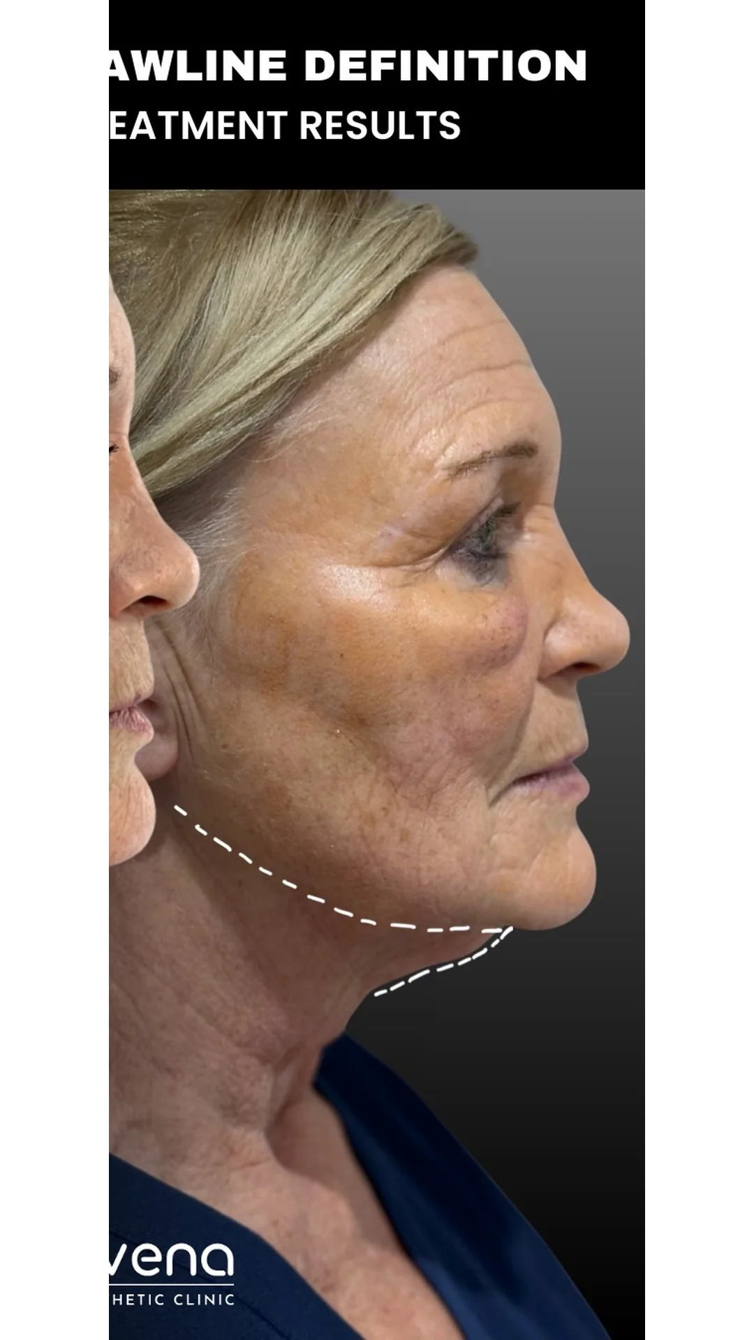 EndoContour after — Rejuvena Clinic Bedford